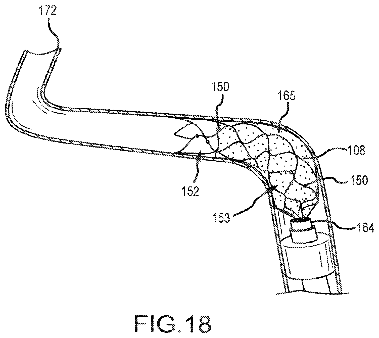 Patent US12599458 Figure 13 – Vascular device marker attachment