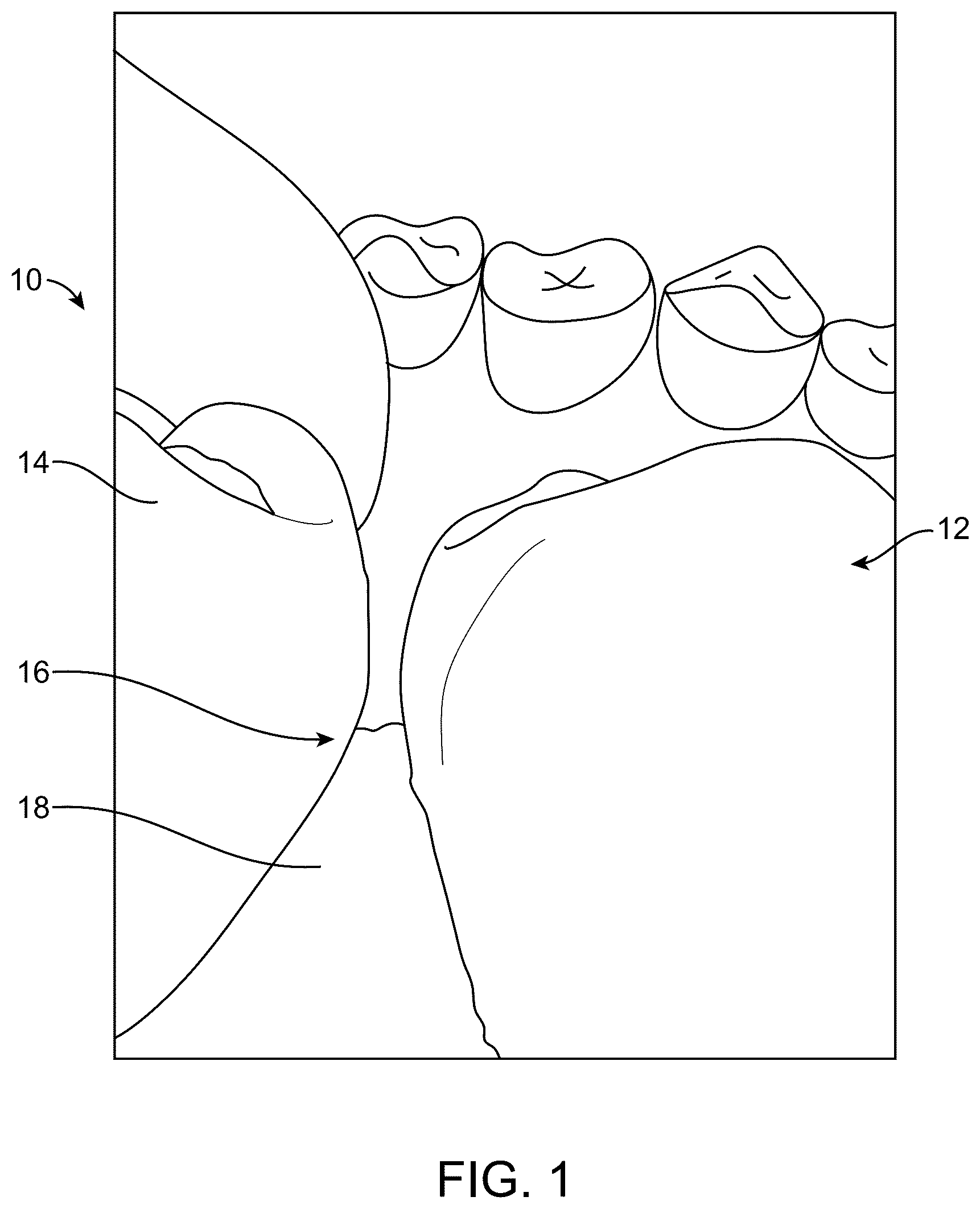 Patent US12599460 Figure 1 – Device for placement in interdental resin fillings