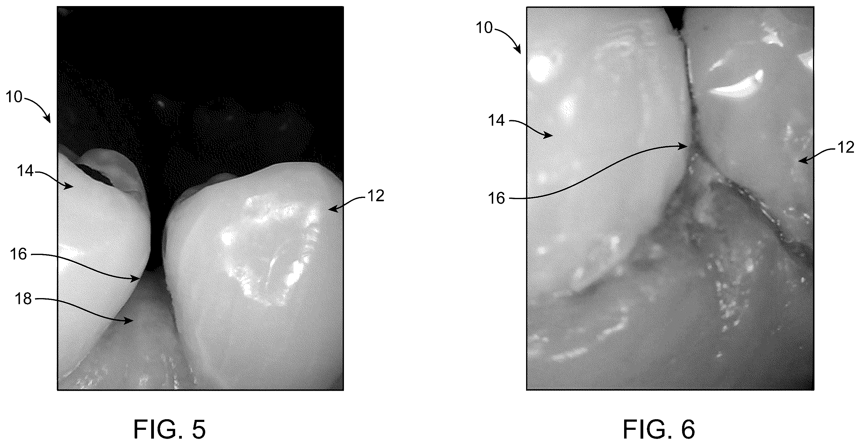 Patent US12599460 Figure 9 – Device for placement in interdental resin fillings