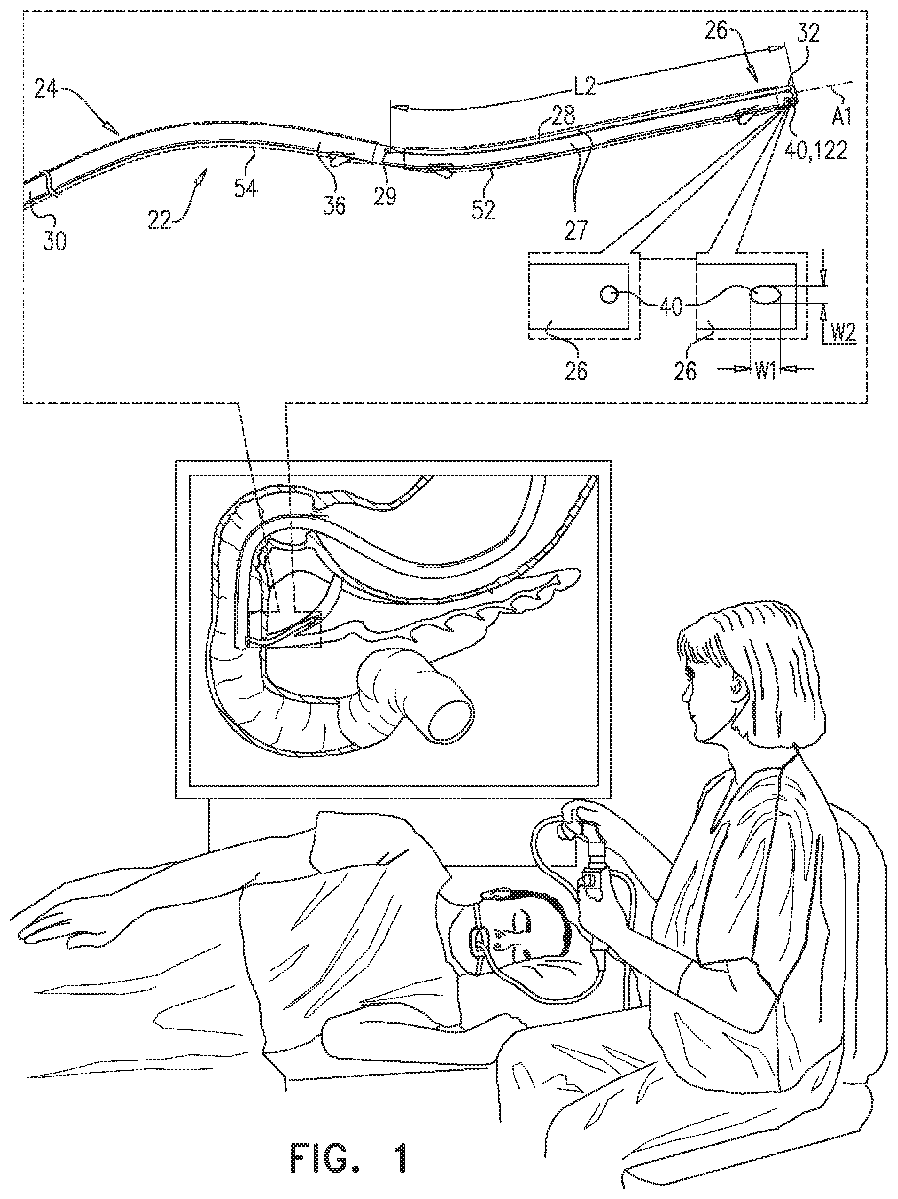 Patent US12599468 Figure 1 – Deployment of multiple biliary stents