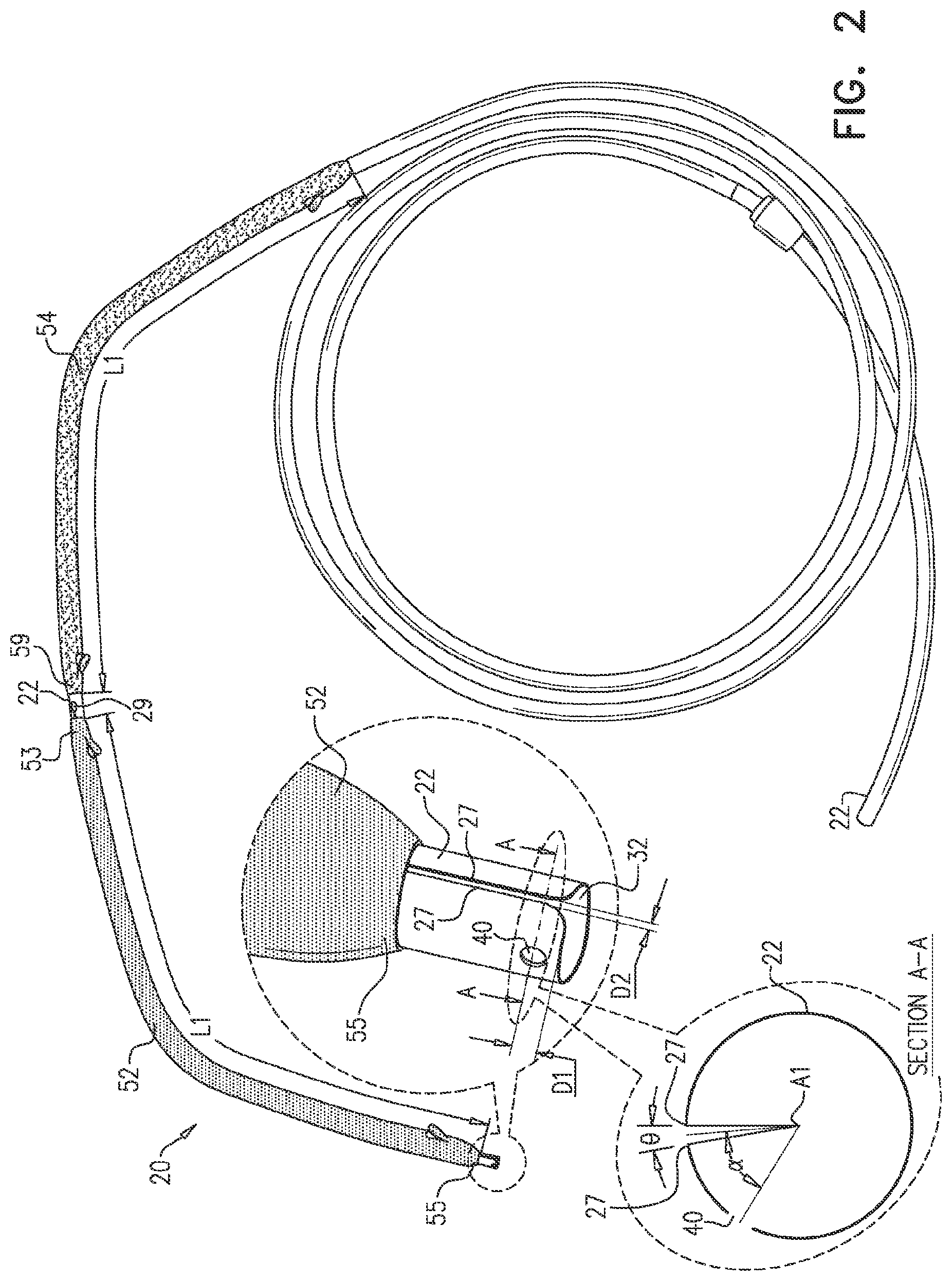 Patent US12599468 Figure 2 – Deployment of multiple biliary stents