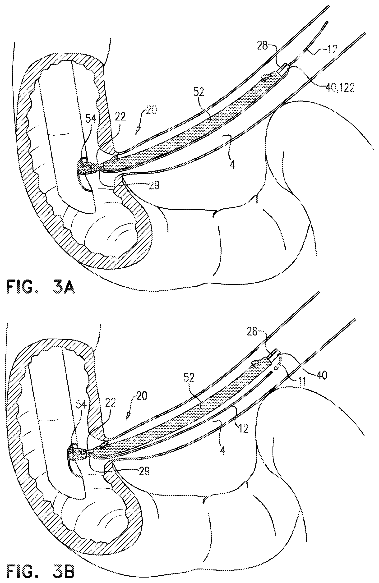 Patent US12599468 Figure 3 – Deployment of multiple biliary stents