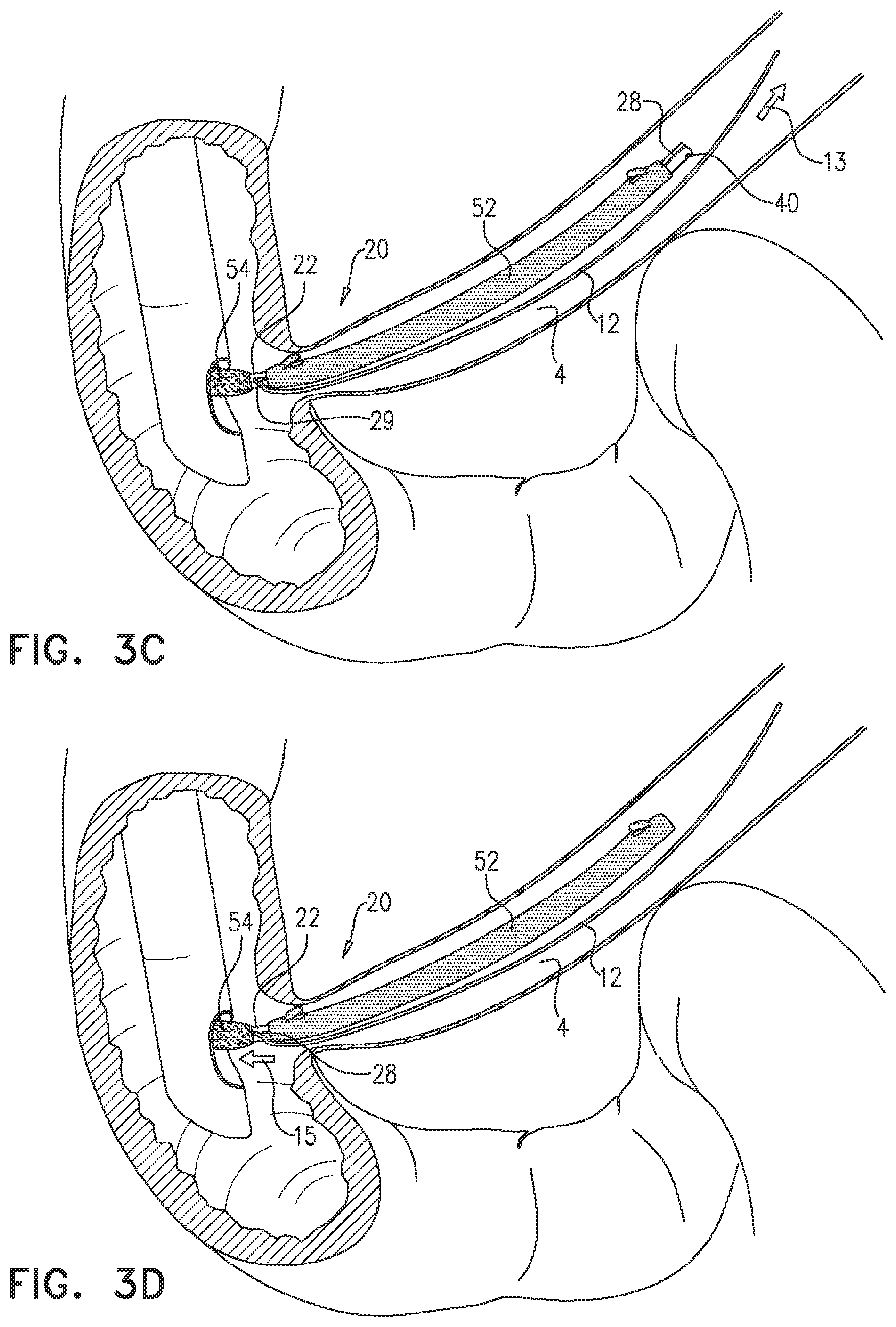 Patent US12599468 Figure 4 – Deployment of multiple biliary stents