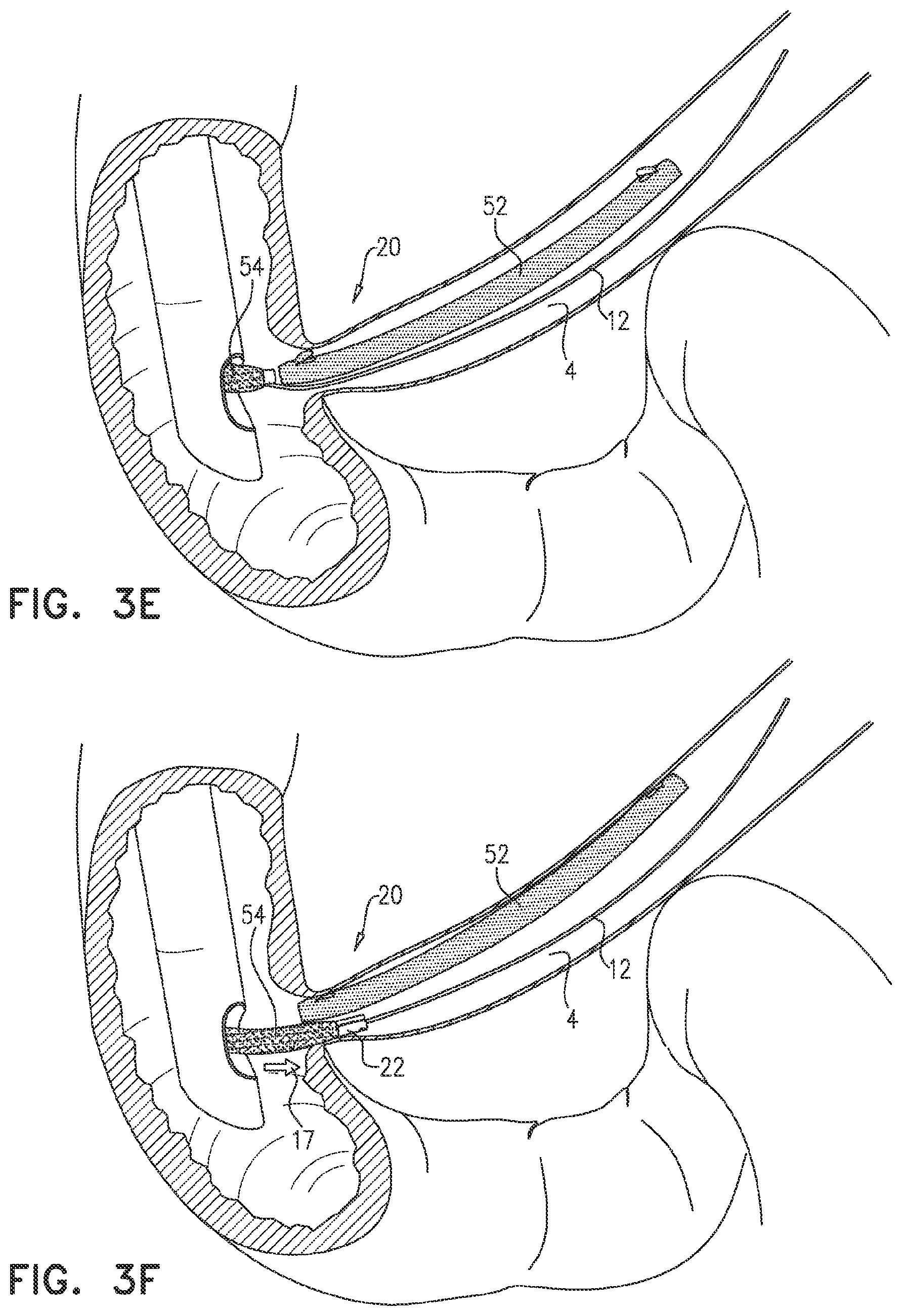 Patent US12599468 Figure 5 – Deployment of multiple biliary stents