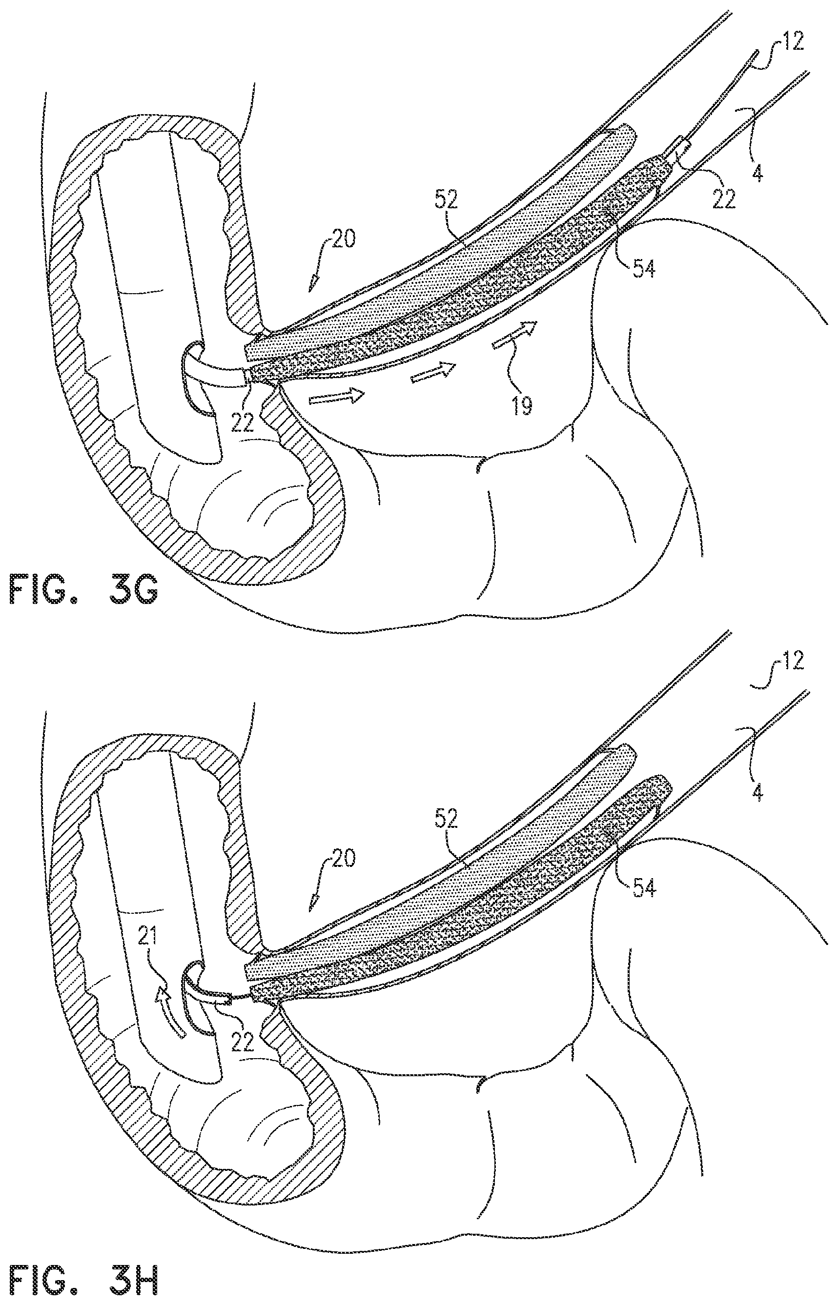 Patent US12599468 Figure 6 – Deployment of multiple biliary stents