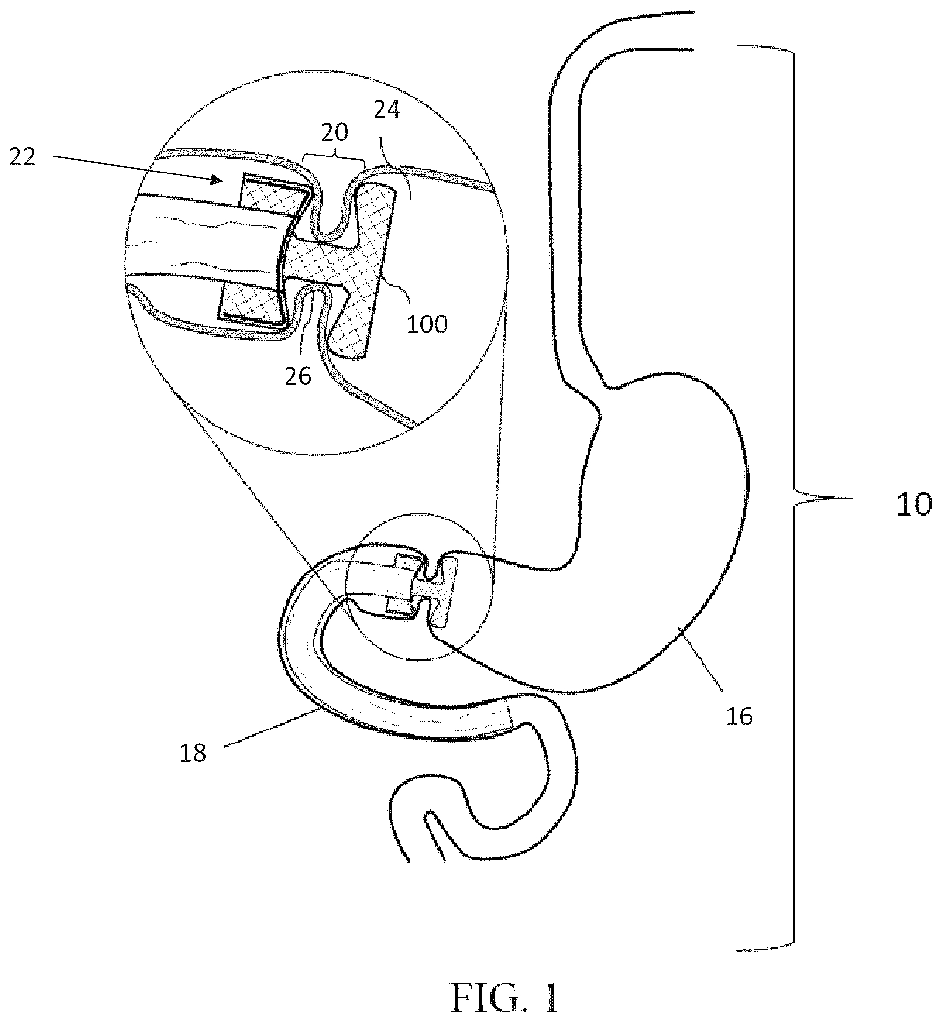 Patent US12599469 Figure 1 – Systems and methods for anchoring and restraining gastrointestinal prostheses