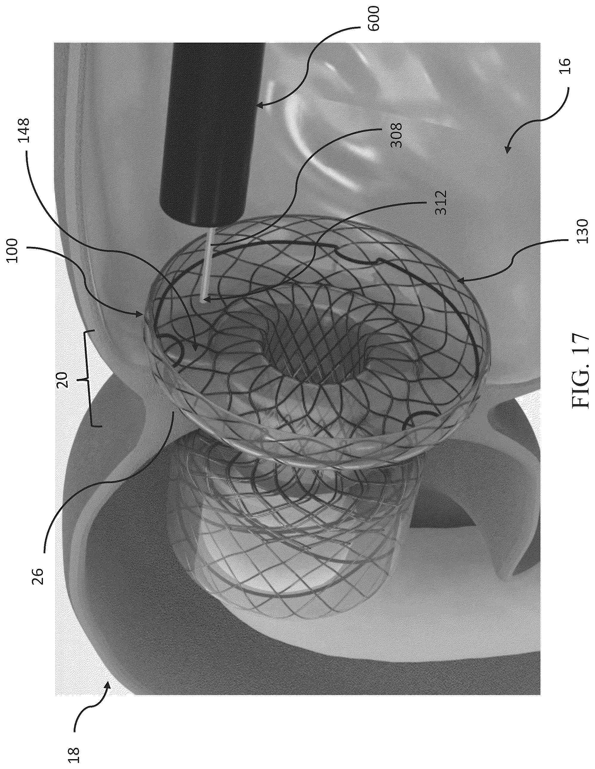 Patent US12599469 Figure 17 – Systems and methods for anchoring and restraining gastrointestinal prostheses