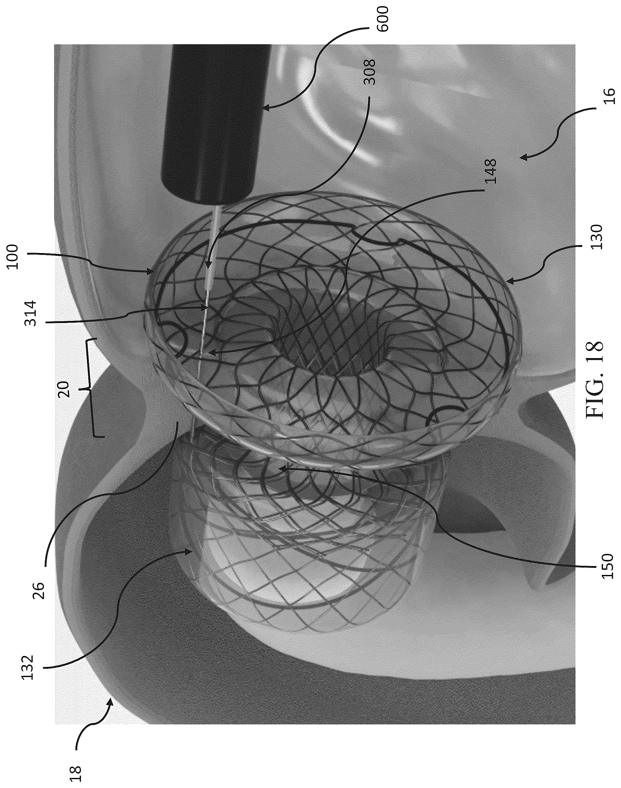 Patent US12599469 Figure 18 – Systems and methods for anchoring and restraining gastrointestinal prostheses