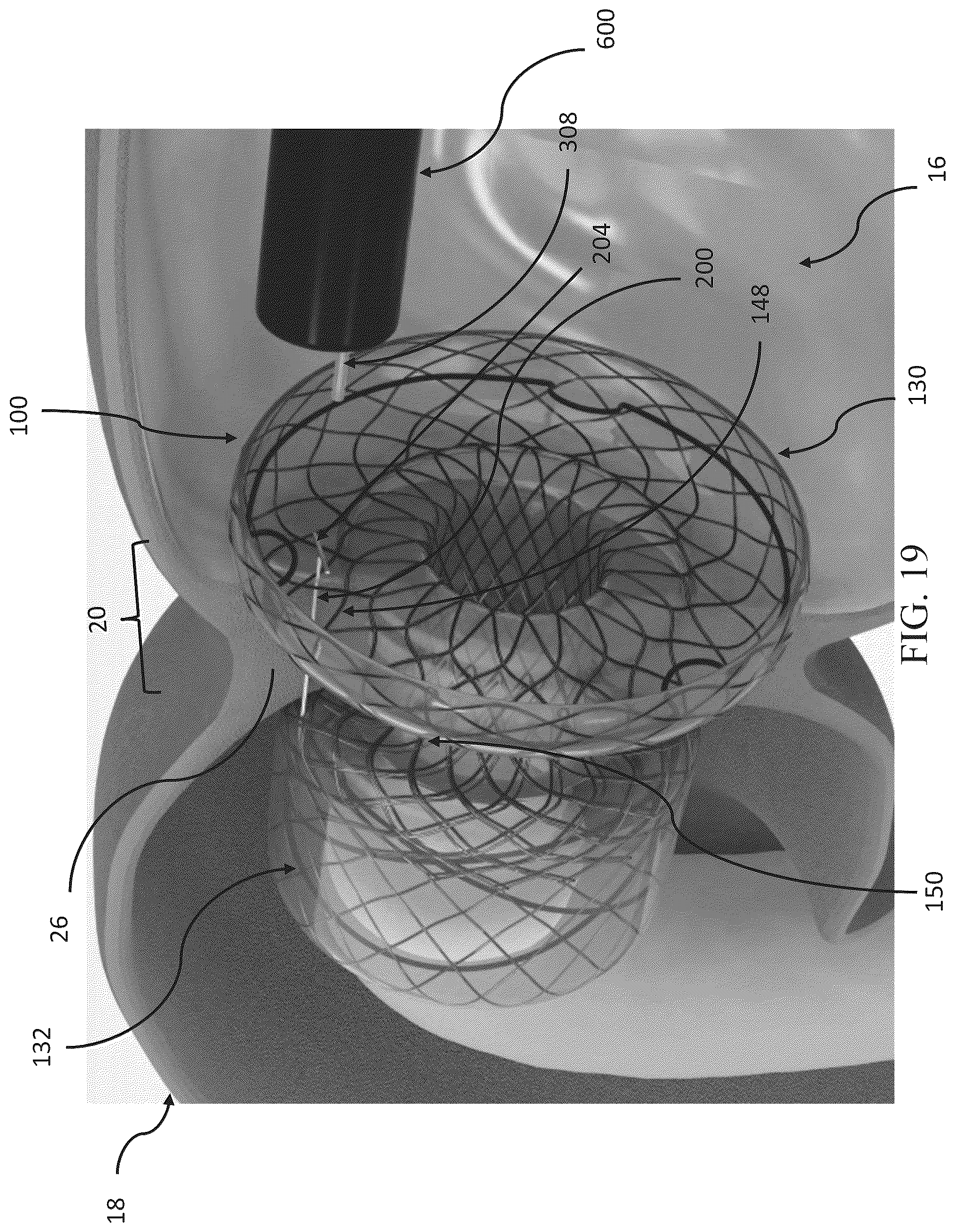 Patent US12599469 Figure 19 – Systems and methods for anchoring and restraining gastrointestinal prostheses