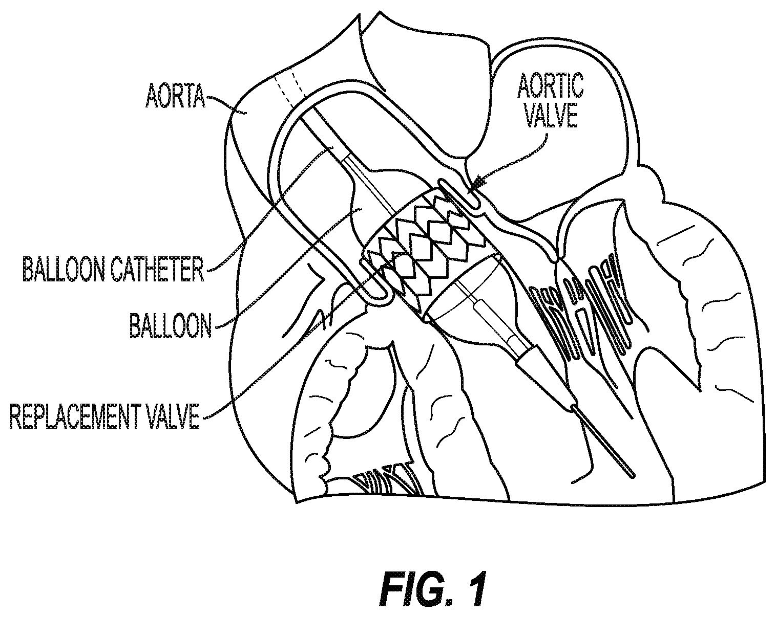 Patent US12599471 Figure 1 – Expandable devices and associated systems and methods