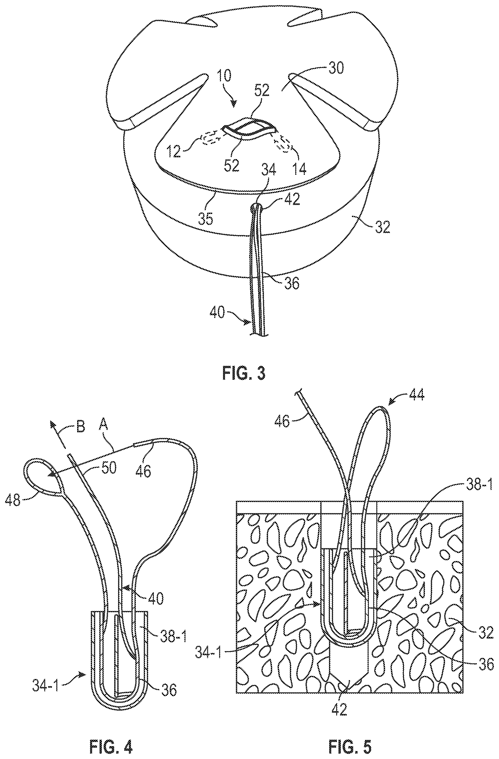 Patent US12599473 Figure 2 – Tensionable knotless tissue repair systems and surgical methods