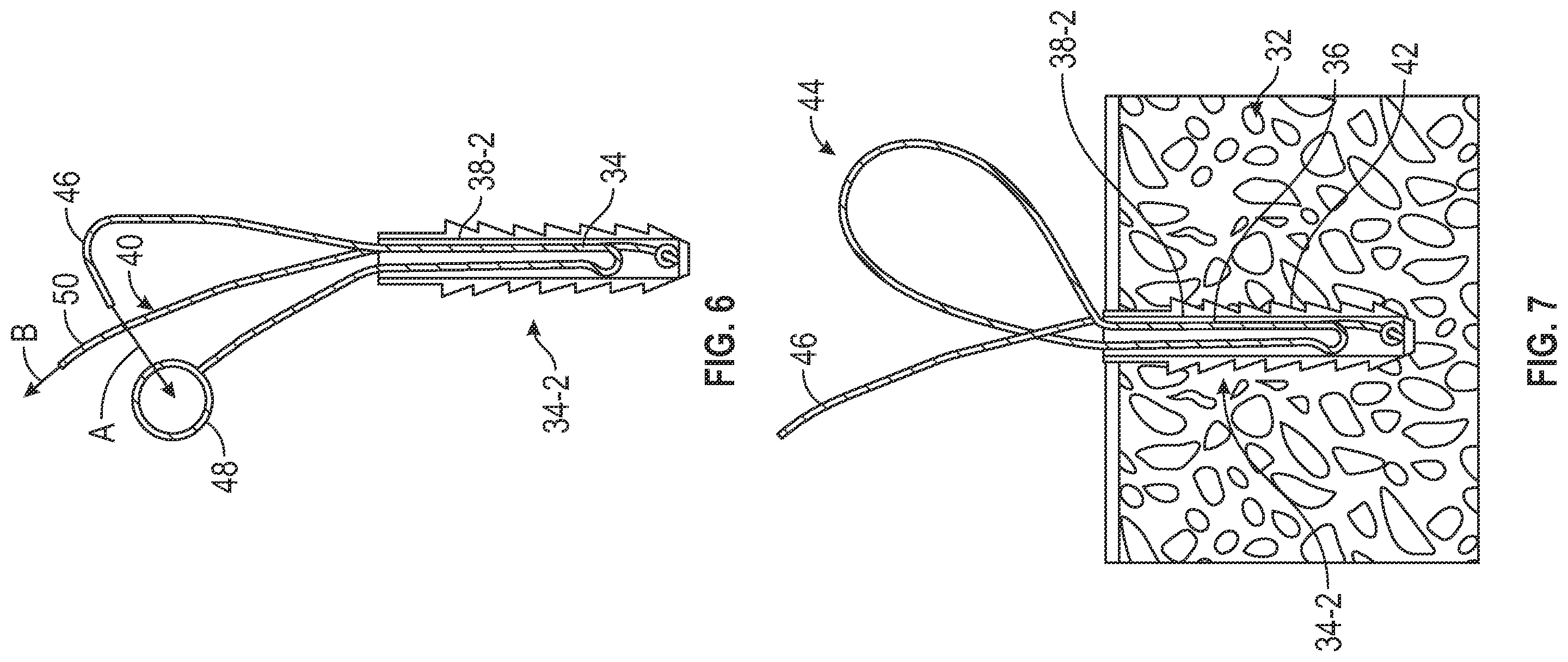 Patent US12599473 Figure 3 – Tensionable knotless tissue repair systems and surgical methods