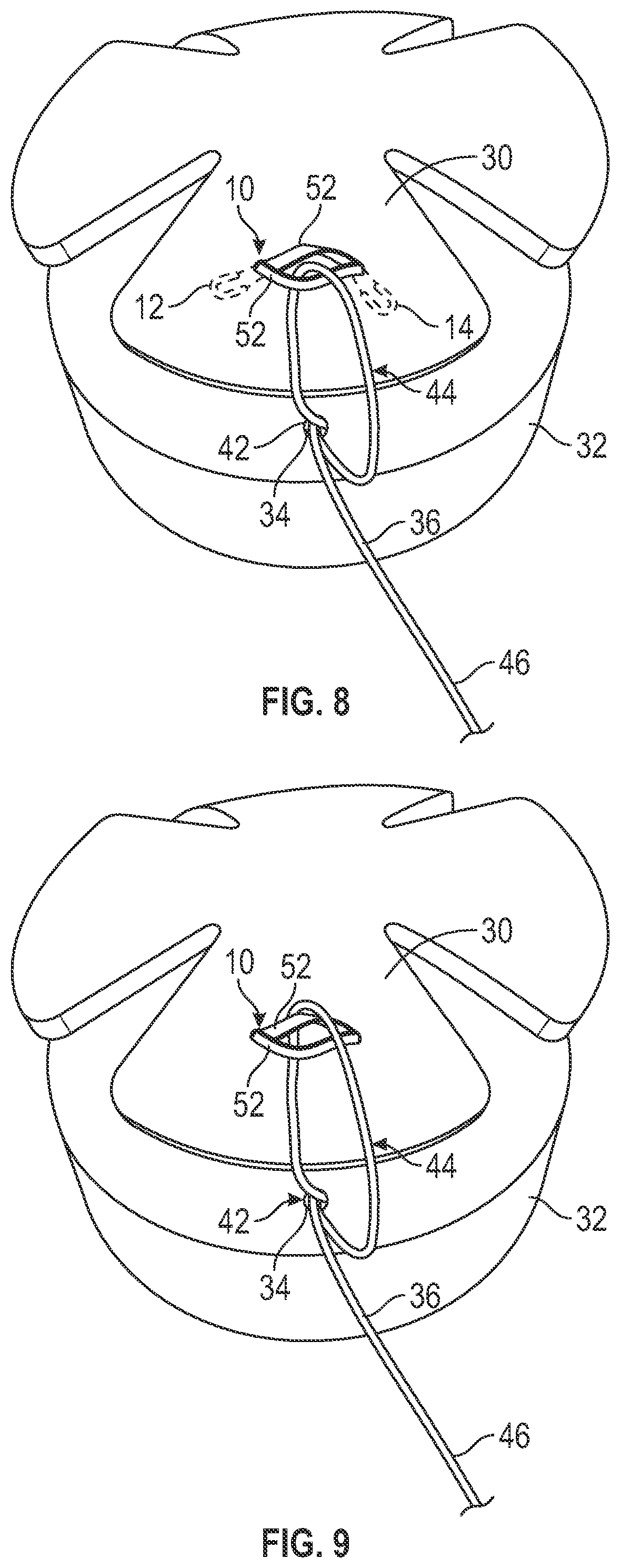 Patent US12599473 Figure 4 – Tensionable knotless tissue repair systems and surgical methods