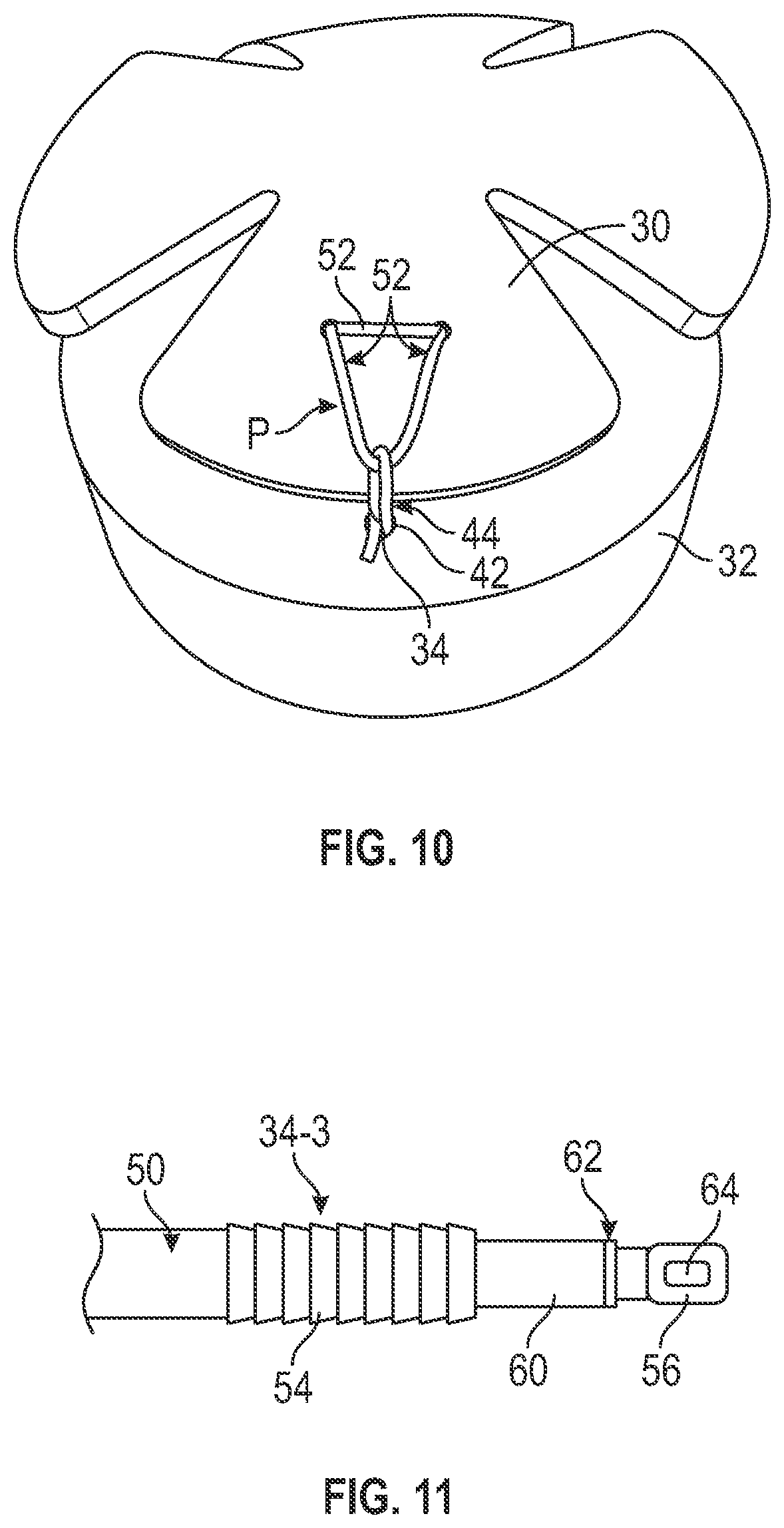 Patent US12599473 Figure 5 – Tensionable knotless tissue repair systems and surgical methods
