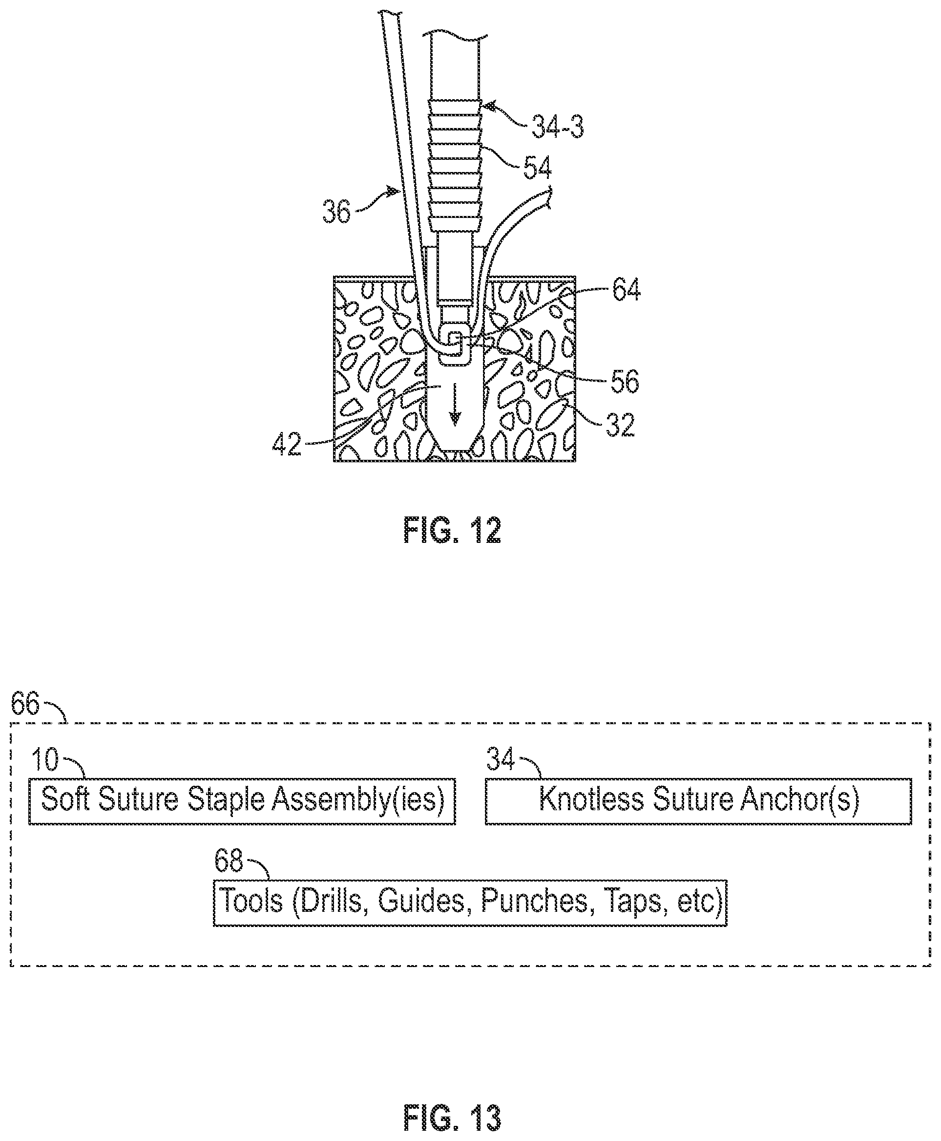 Patent US12599473 Figure 6 – Tensionable knotless tissue repair systems and surgical methods
