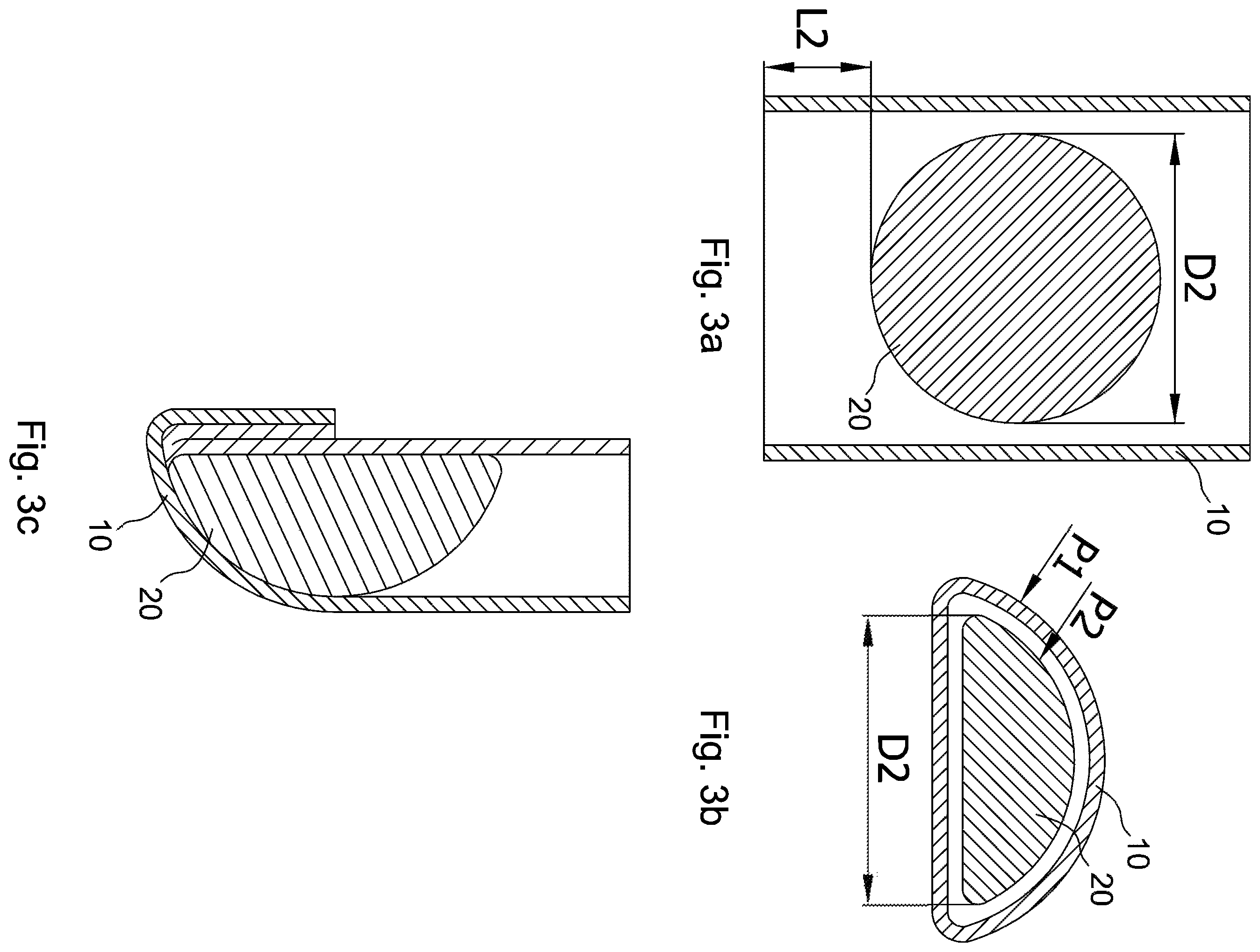 Patent US12599474 Figure 2 – Tubular mesh support device for a breast implant and method for preparing the breast implant