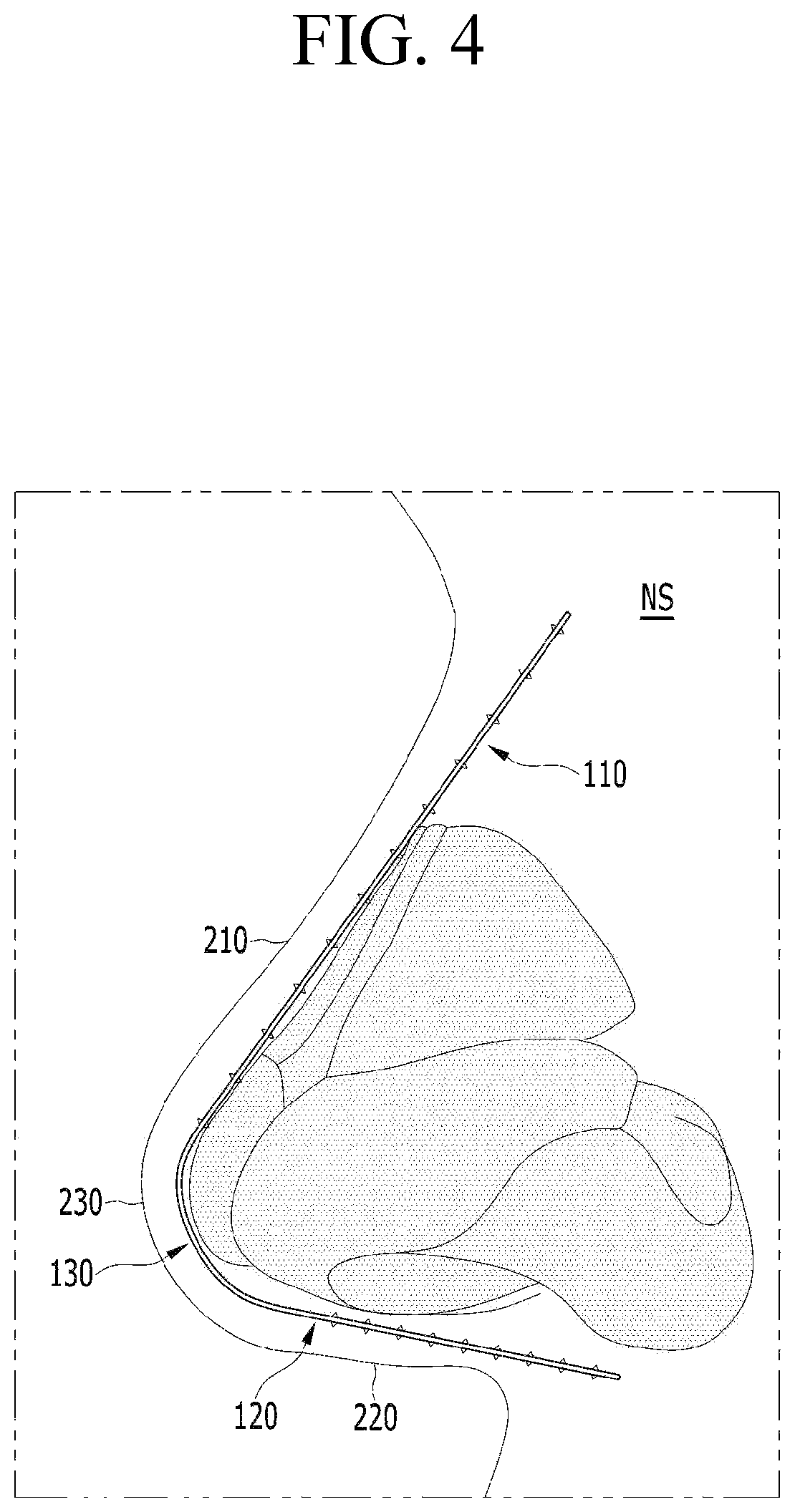 Patent US12599478 Figure 4 – Lifting suture for rhinoplasty and manufacturing method thereof