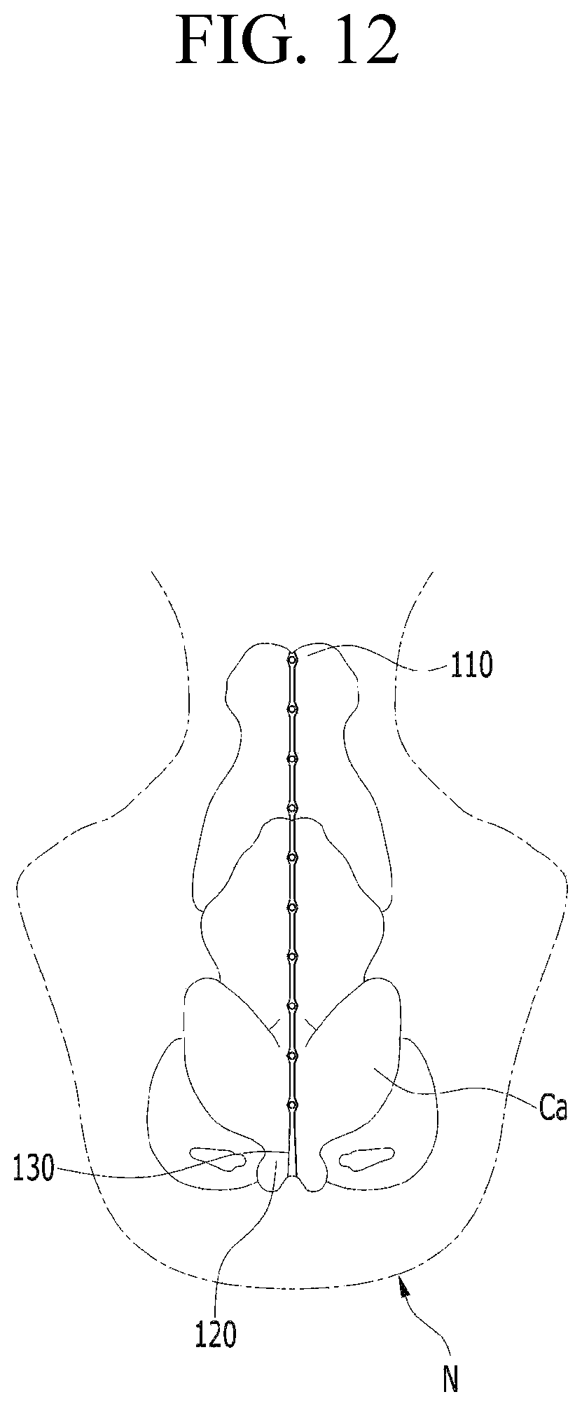 Patent US12599478 Figure 11 – Lifting suture for rhinoplasty and manufacturing method thereof