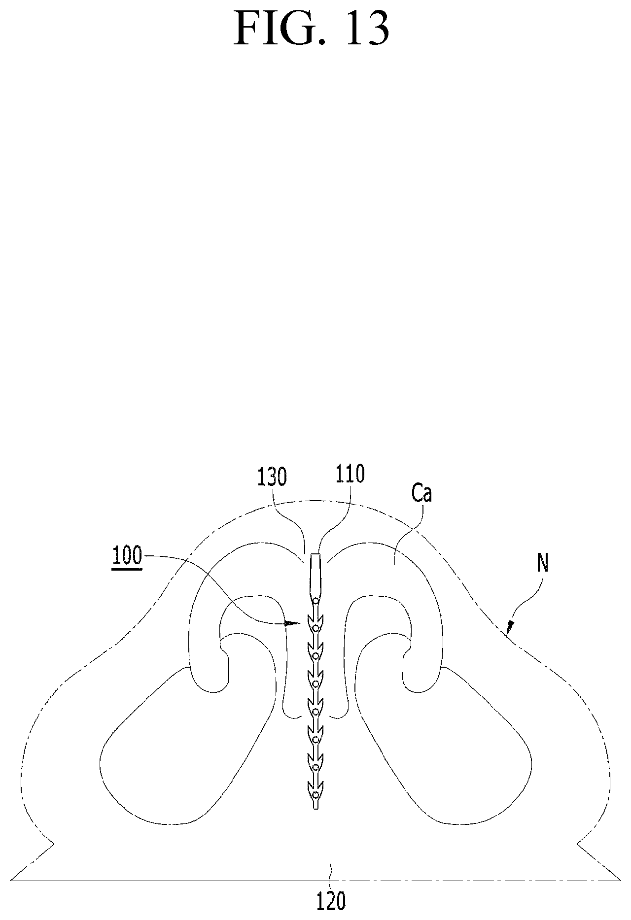 Patent US12599478 Figure 12 – Lifting suture for rhinoplasty and manufacturing method thereof