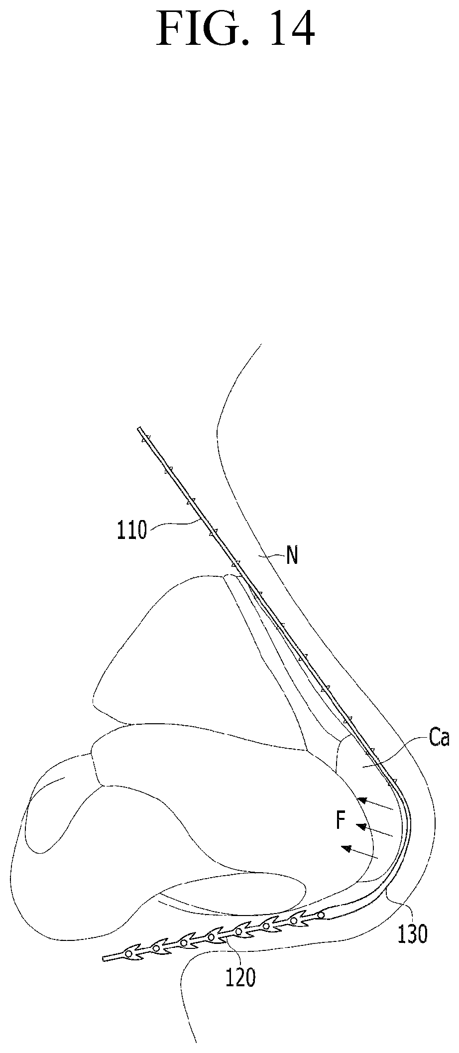 Patent US12599478 Figure 13 – Lifting suture for rhinoplasty and manufacturing method thereof