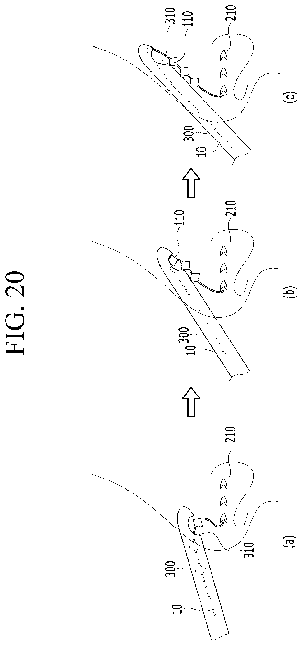 Patent US12599478 Figure 19 – Lifting suture for rhinoplasty and manufacturing method thereof