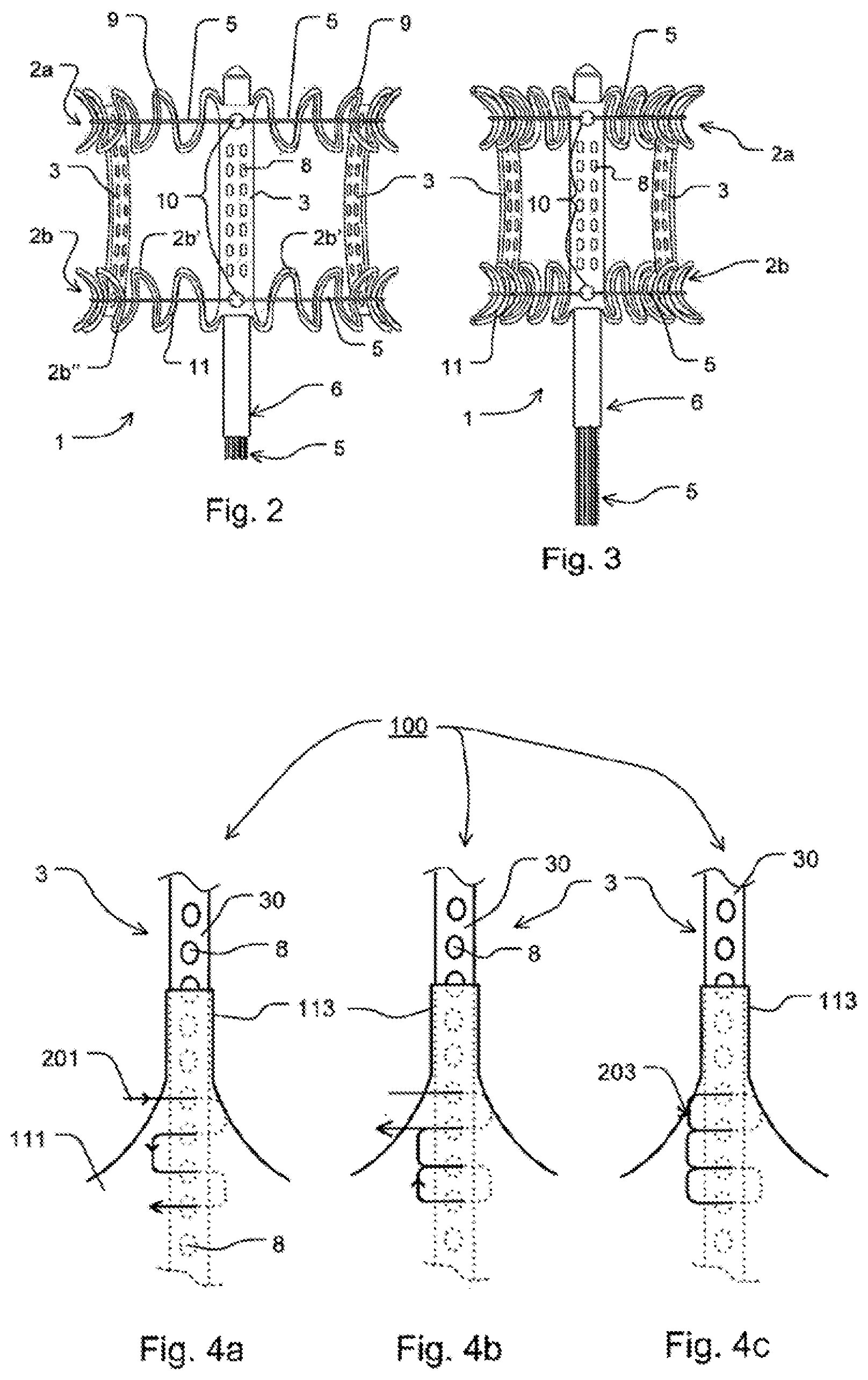 Patent US12599479 Figure 2 – Heart valve comprising a crown piece interconnected to leaflets, a top cuff and a bottom cuff; and a medical implant