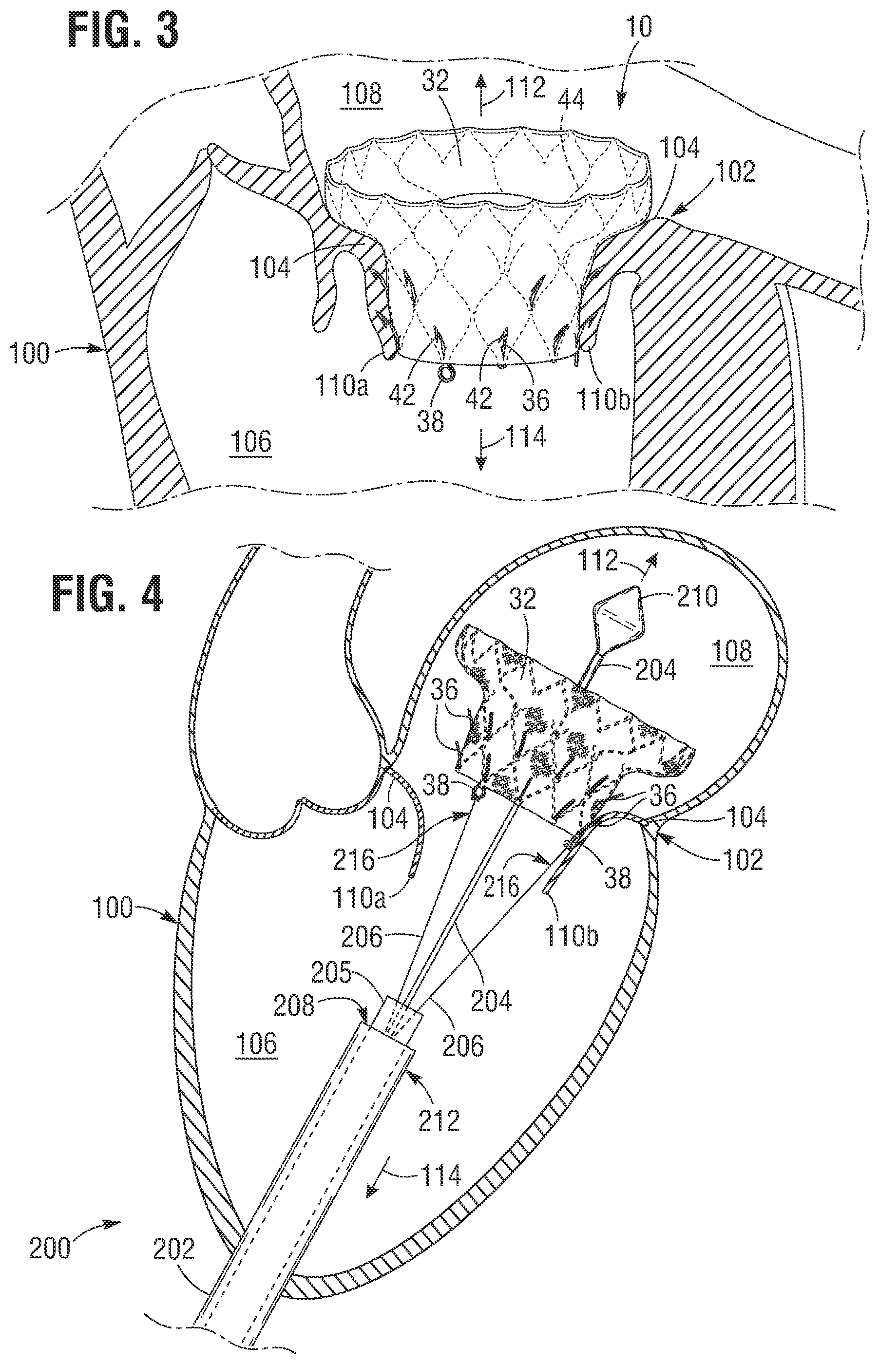 Patent US12599480 Figure 2 – Percutaneous mitral valve replacement device