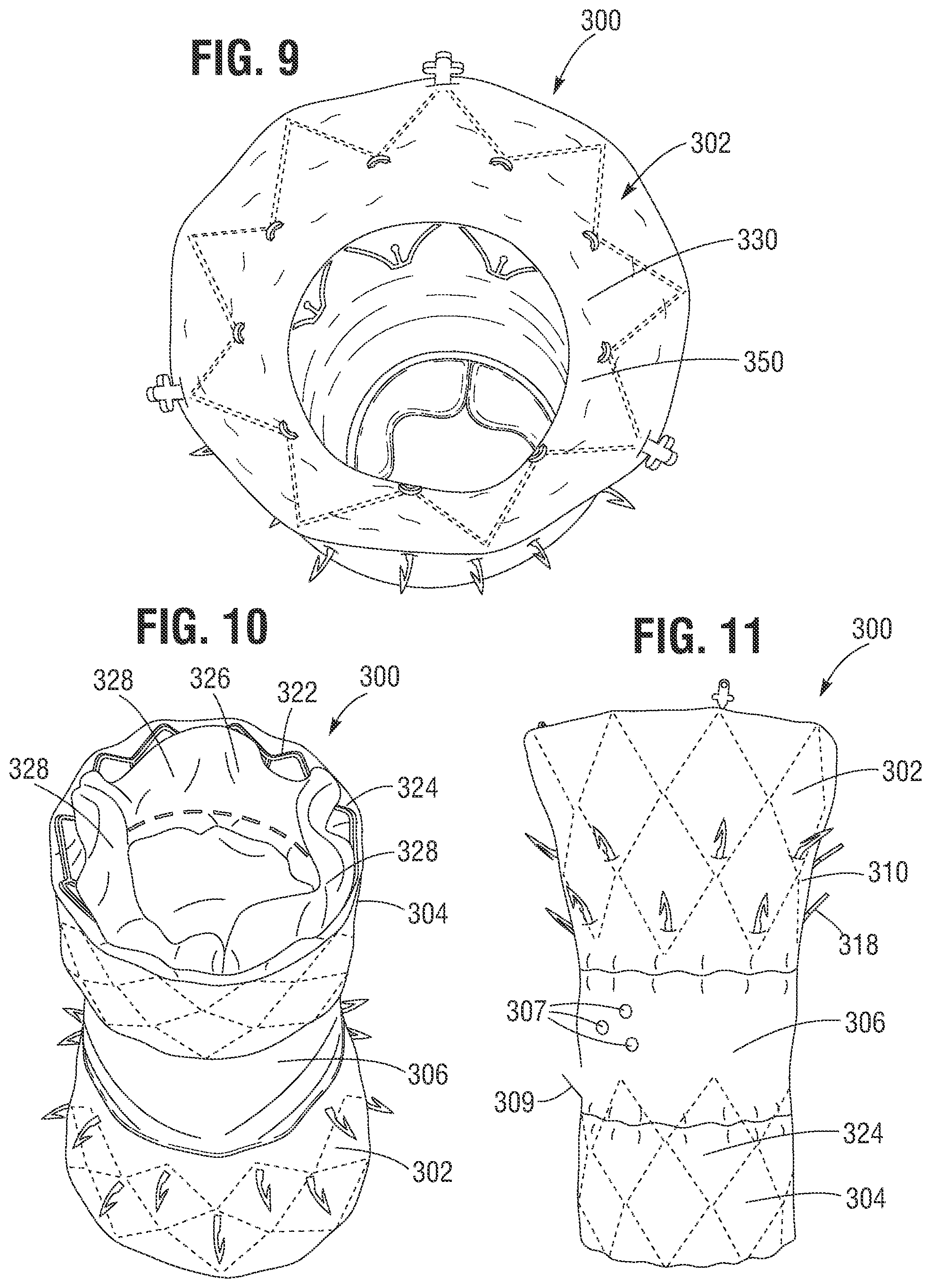 Patent US12599480 Figure 5 – Percutaneous mitral valve replacement device