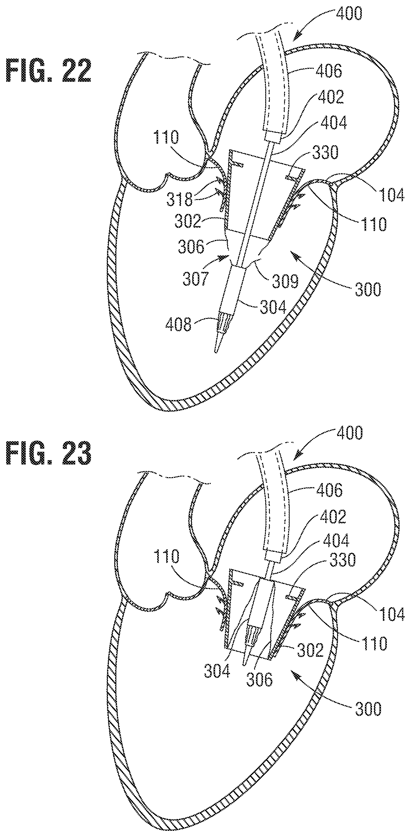 Patent US12599480 Figure 11 – Percutaneous mitral valve replacement device
