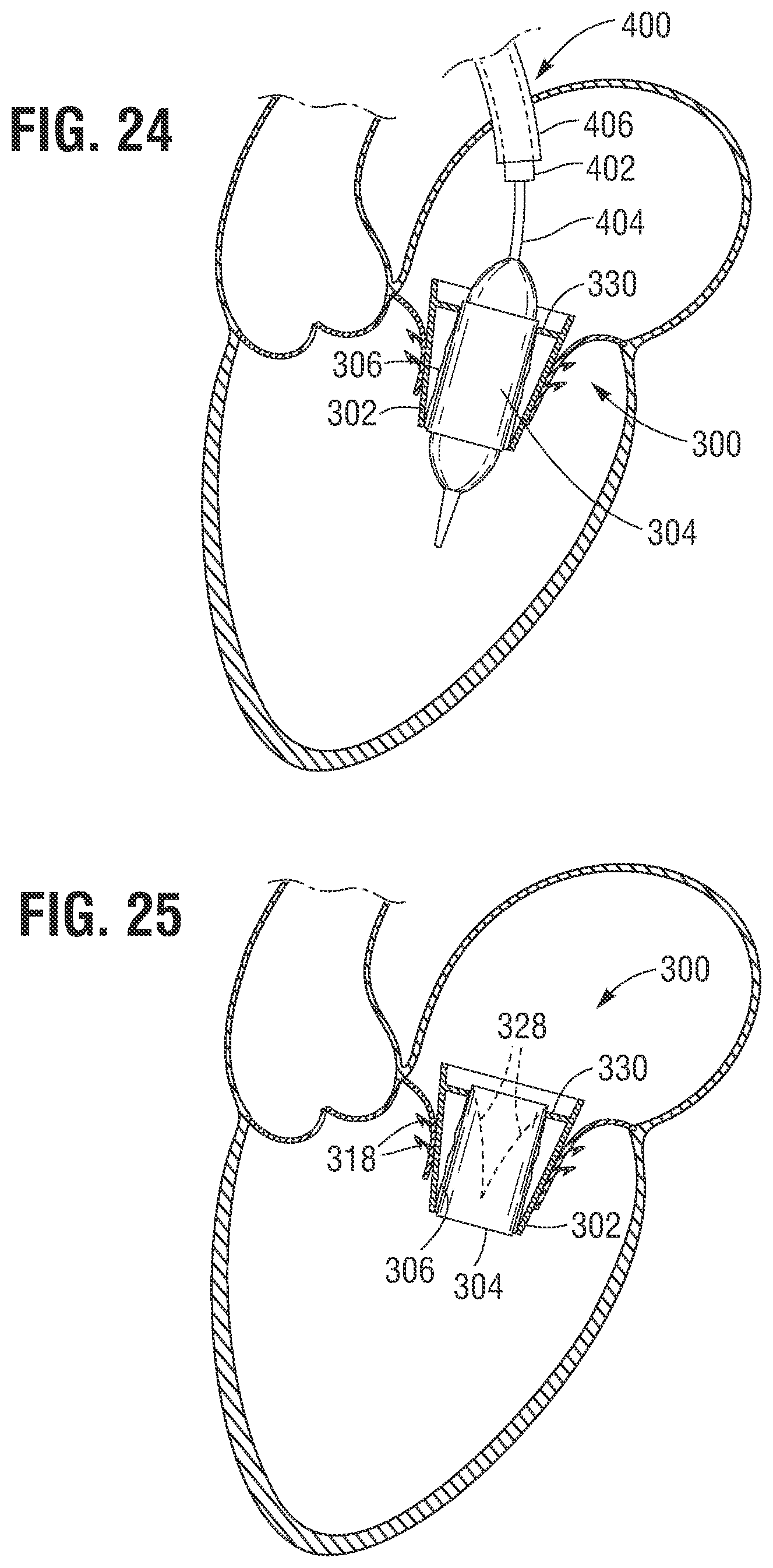 Patent US12599480 Figure 12 – Percutaneous mitral valve replacement device