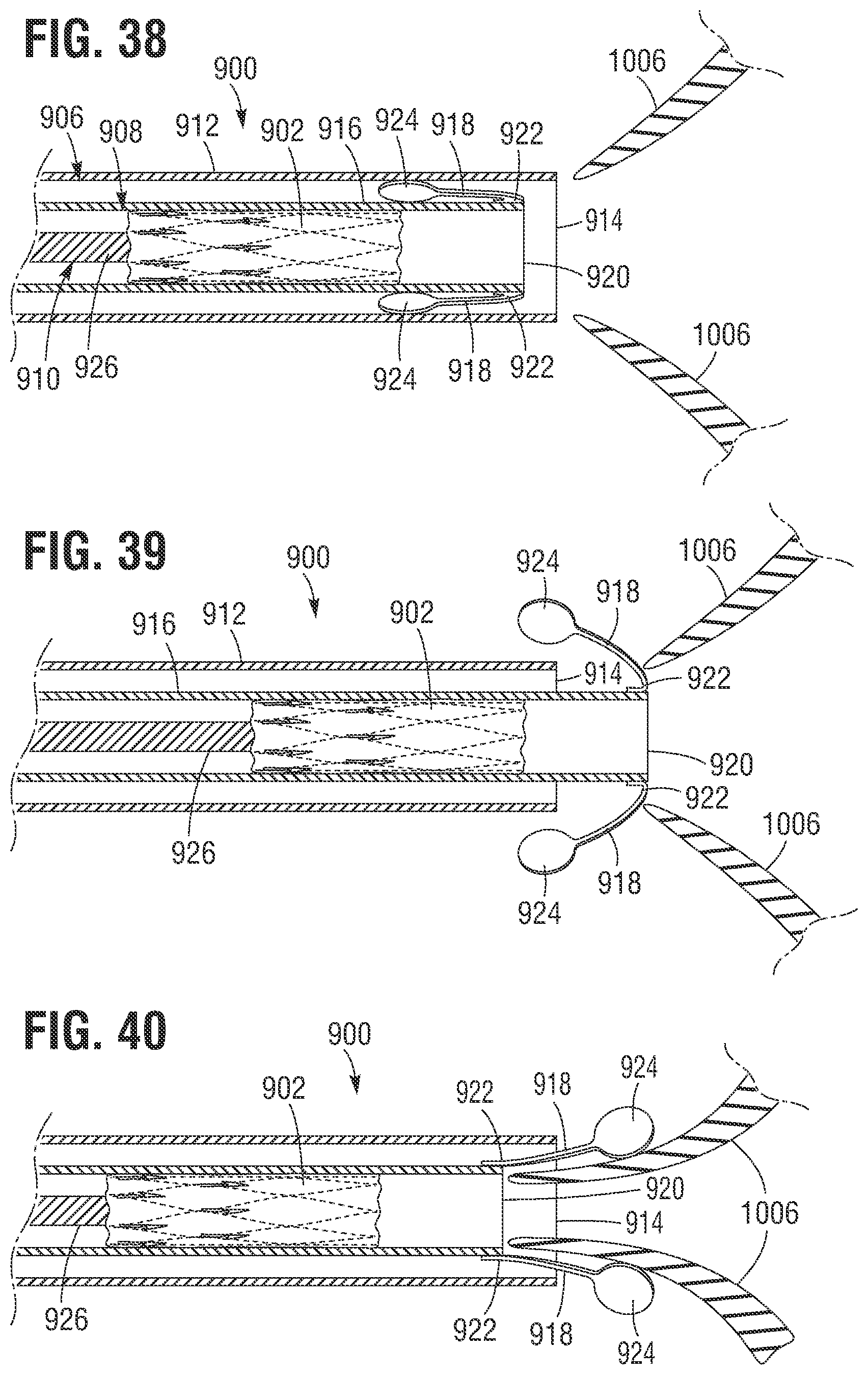 Patent US12599480 Figure 18 – Percutaneous mitral valve replacement device