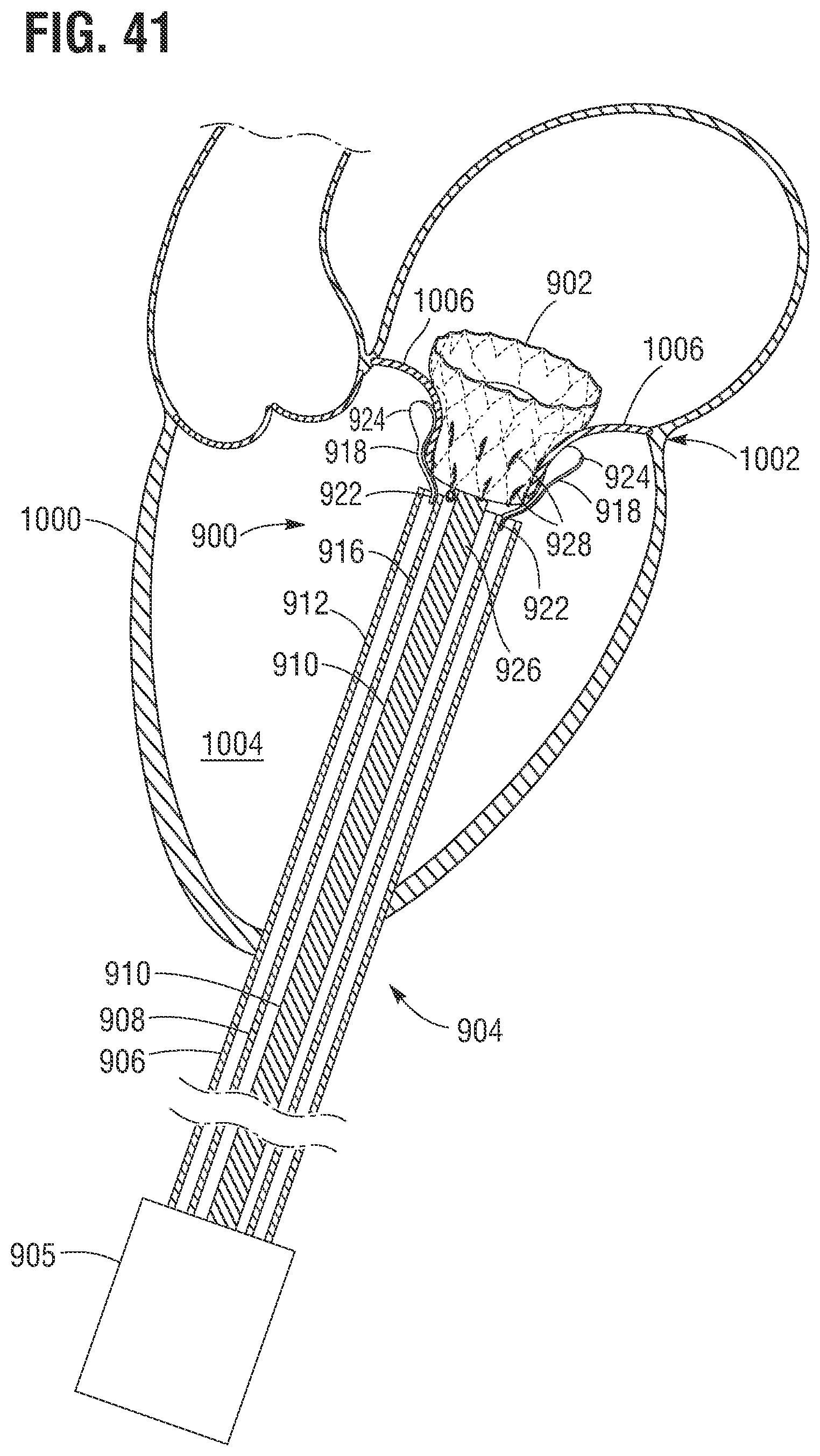 Patent US12599480 Figure 19 – Percutaneous mitral valve replacement device
