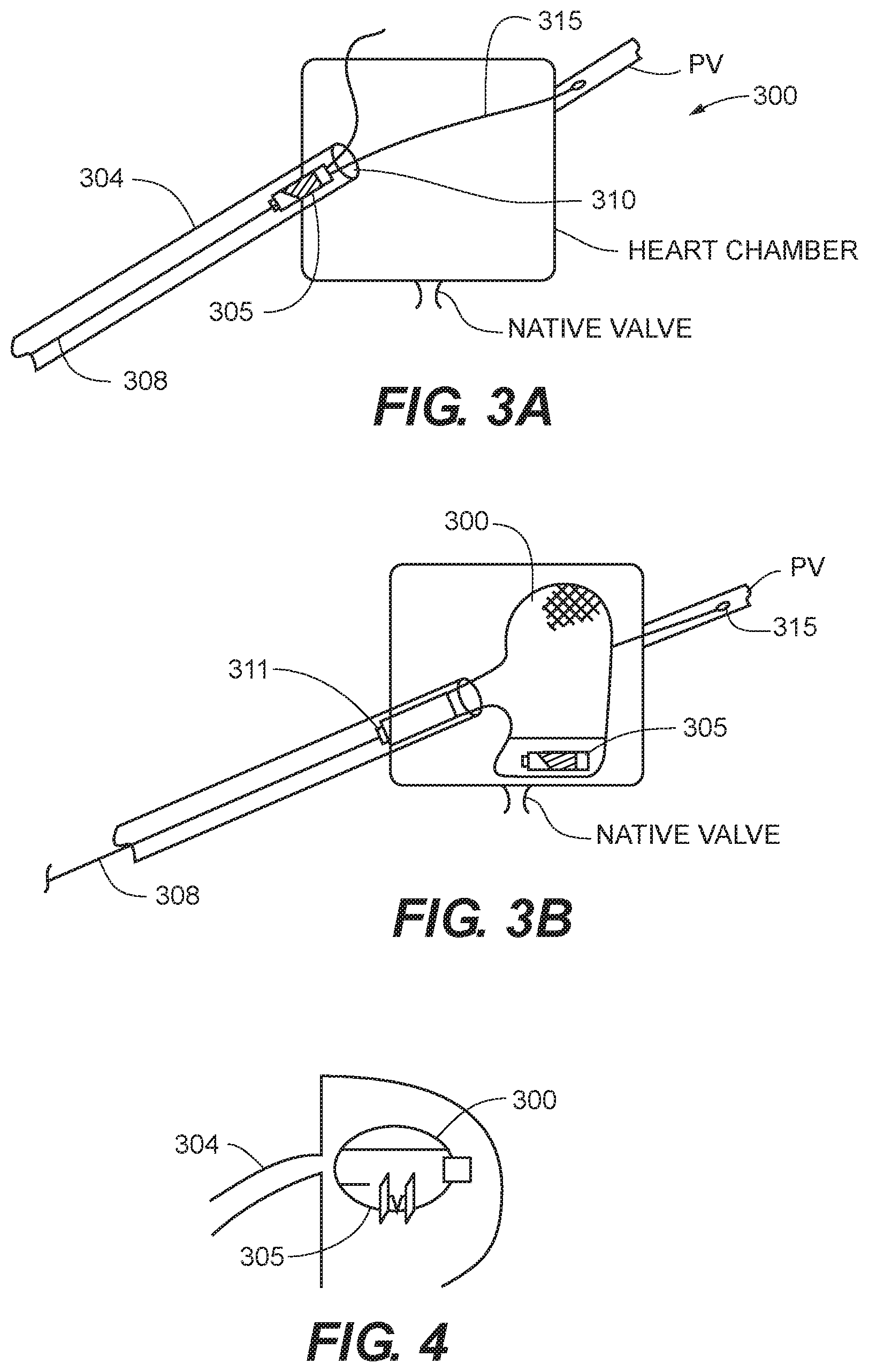 Patent US12599481 Figure 2 – Systems, methods and devices for delivery systems, methods and devices for implanting prosthetic heart valves