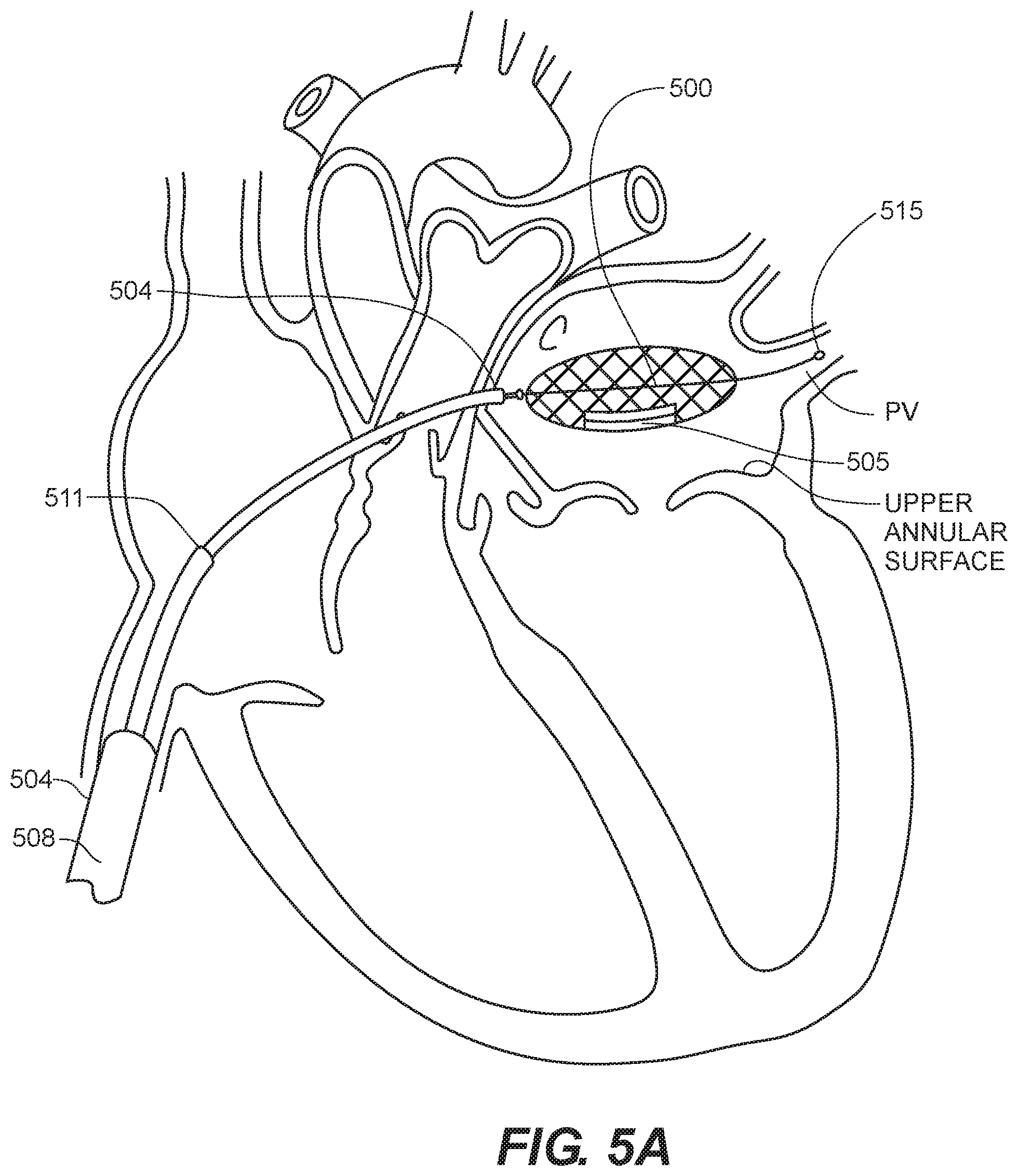 Patent US12599481 Figure 3 – Systems, methods and devices for delivery systems, methods and devices for implanting prosthetic heart valves
