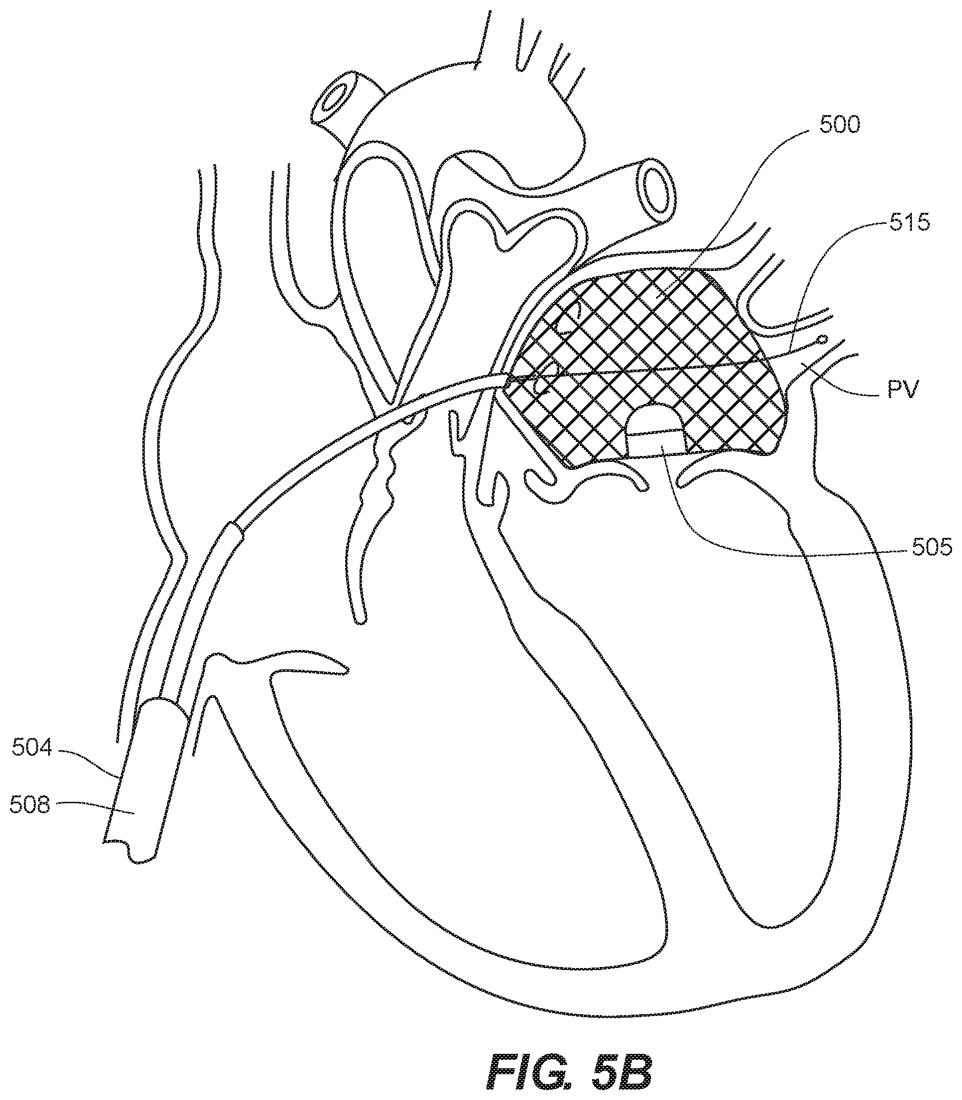 Patent US12599481 Figure 4 – Systems, methods and devices for delivery systems, methods and devices for implanting prosthetic heart valves