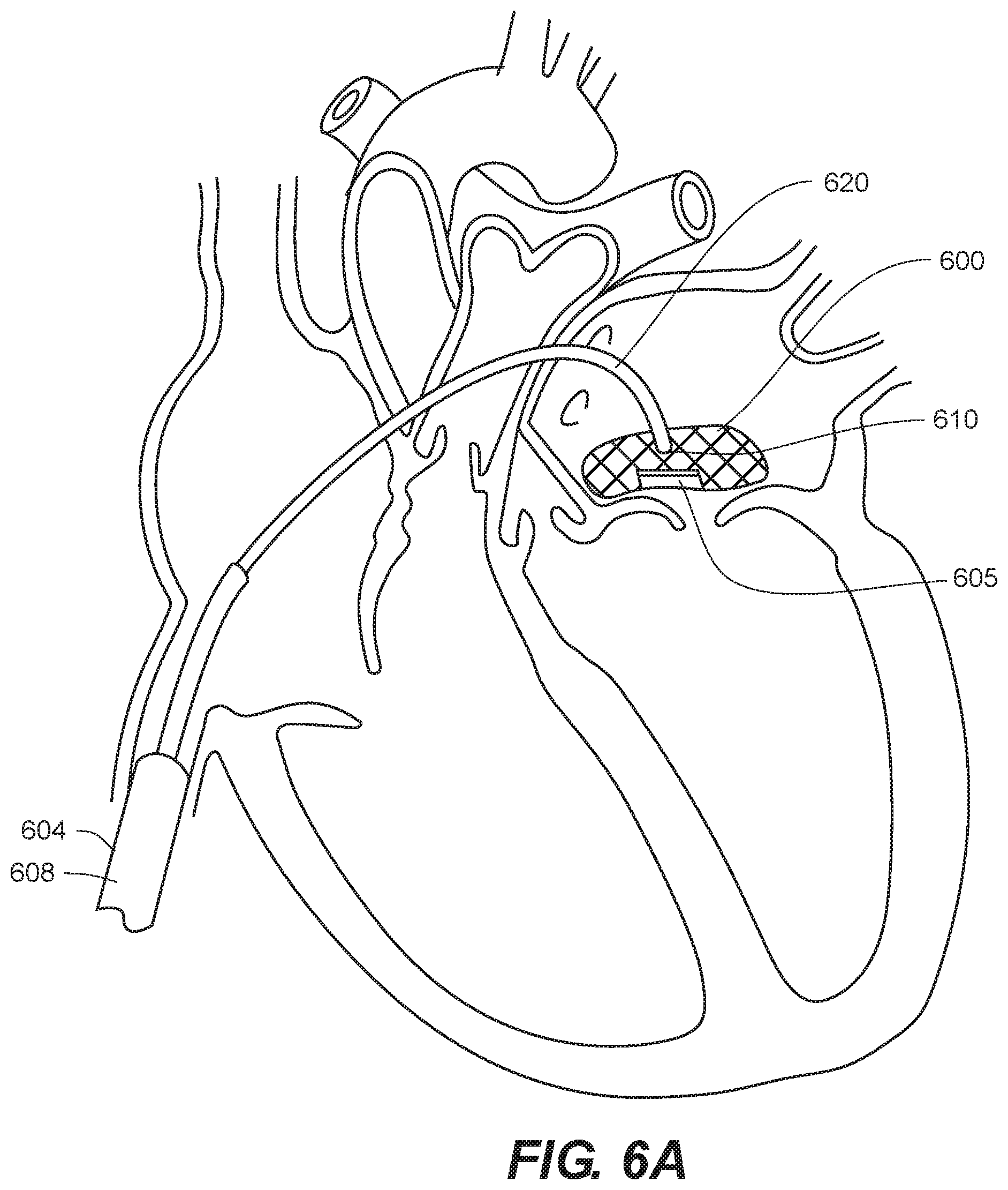 Patent US12599481 Figure 5 – Systems, methods and devices for delivery systems, methods and devices for implanting prosthetic heart valves