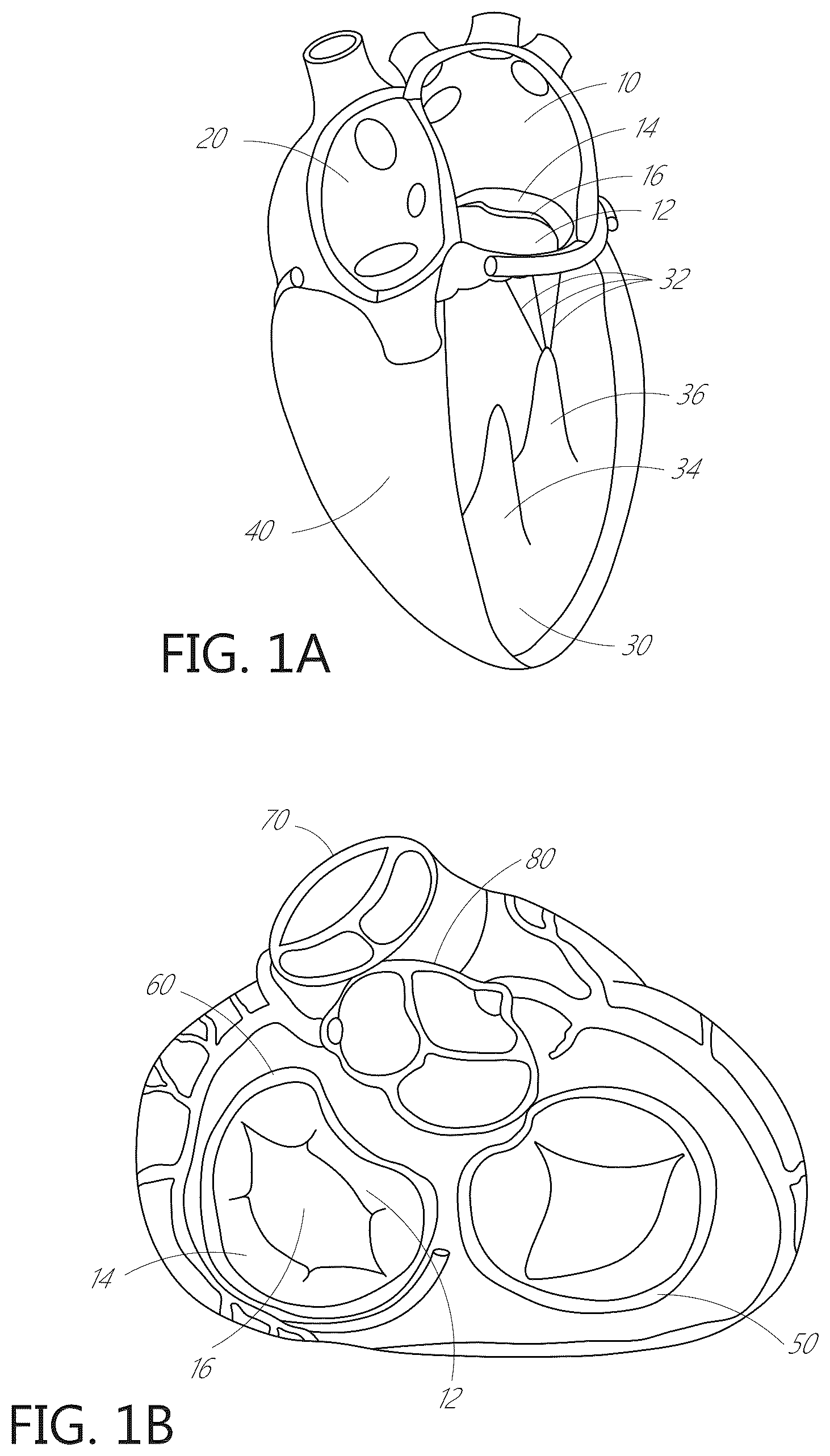 Patent US12599482 — Device, system, and method for transcatheter treatment of valvular regurgitation with secondary anchors — Figure 1