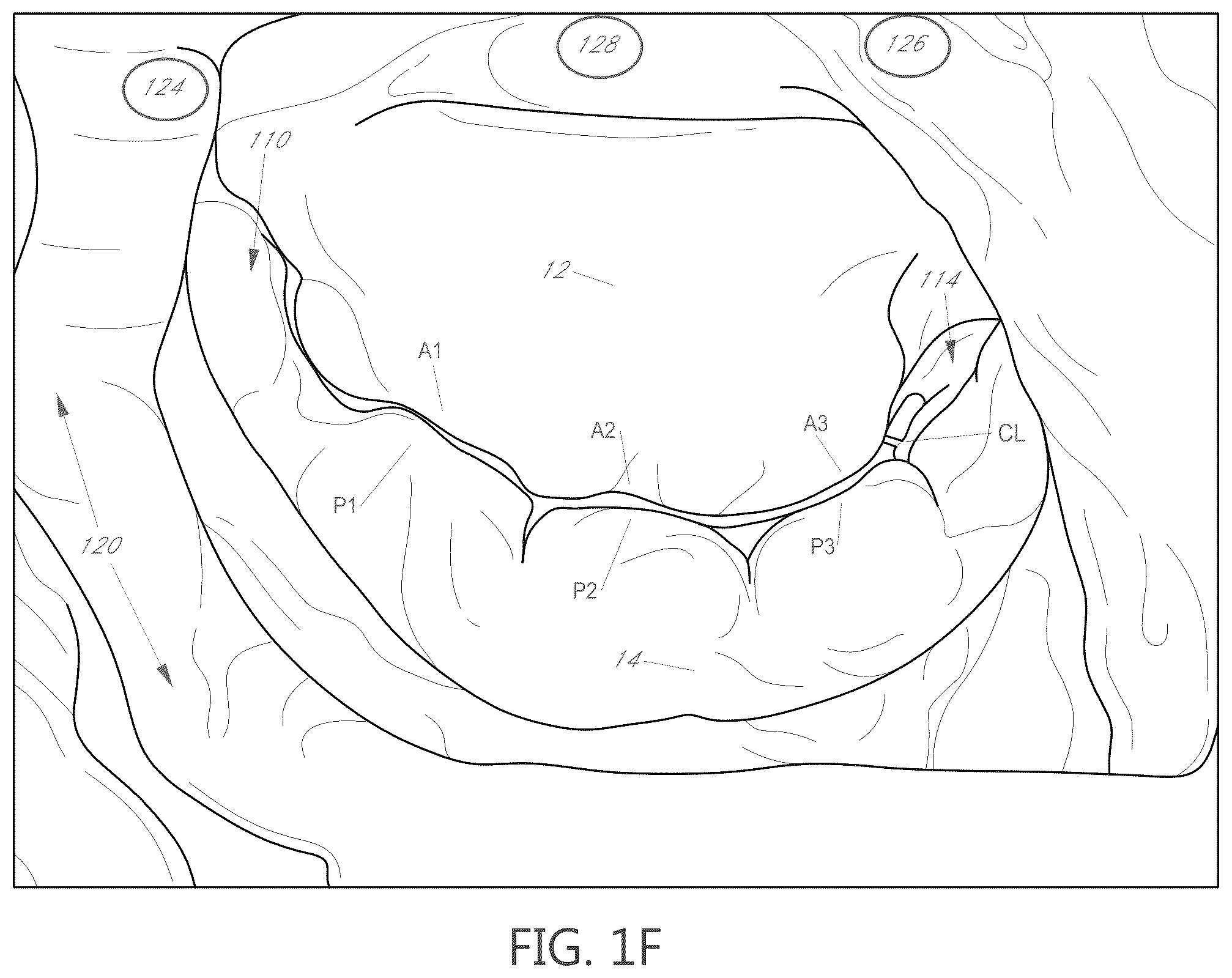Patent US12599482 Figure 4 – Device, system, and method for transcatheter treatment of valvular regurgitation with secondary anchors