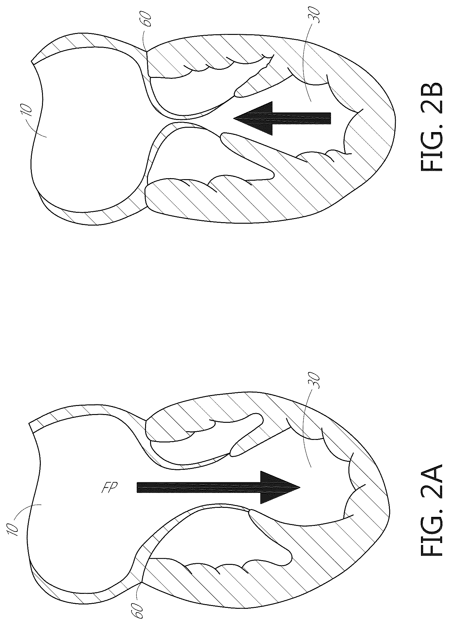 Patent US12599482 Figure 5 – Device, system, and method for transcatheter treatment of valvular regurgitation with secondary anchors