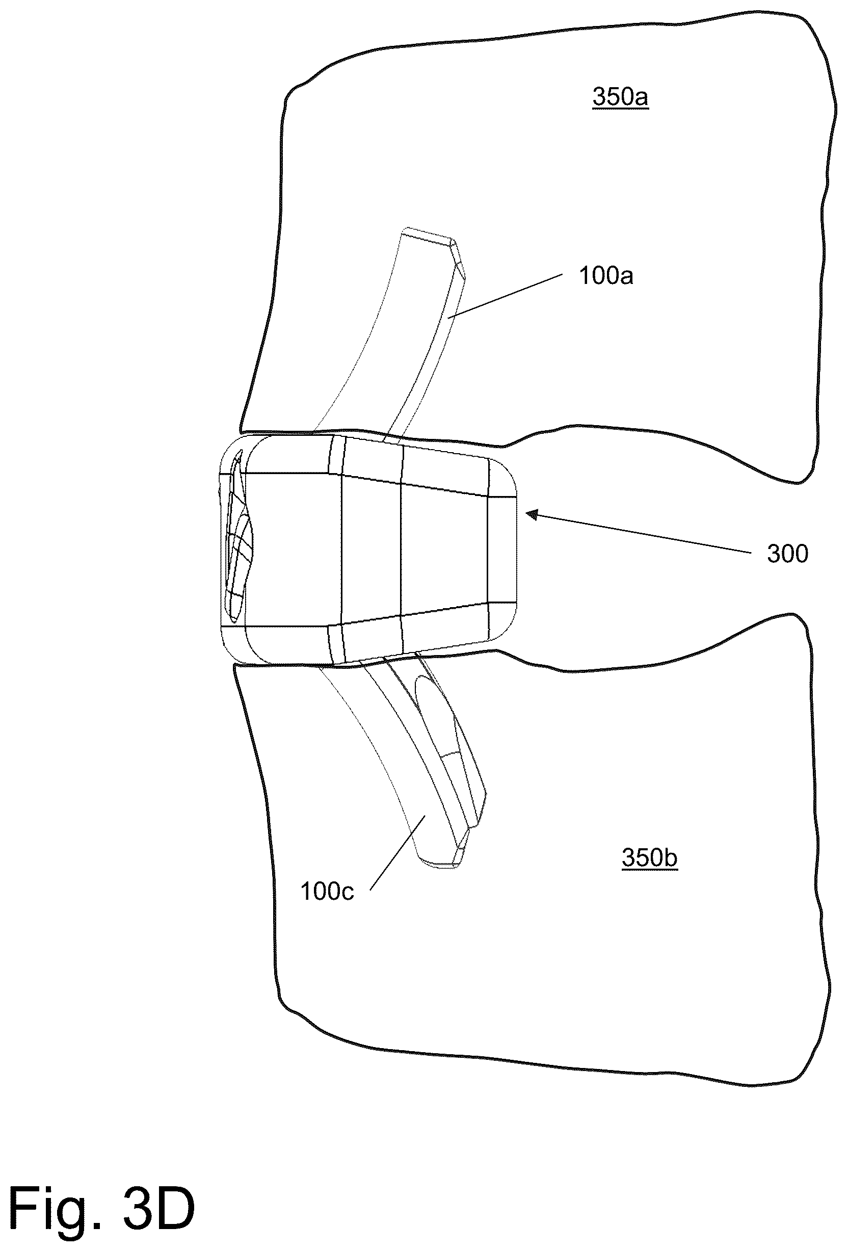 Patent US12599483 Figure 8 – System and method for joining boney structures