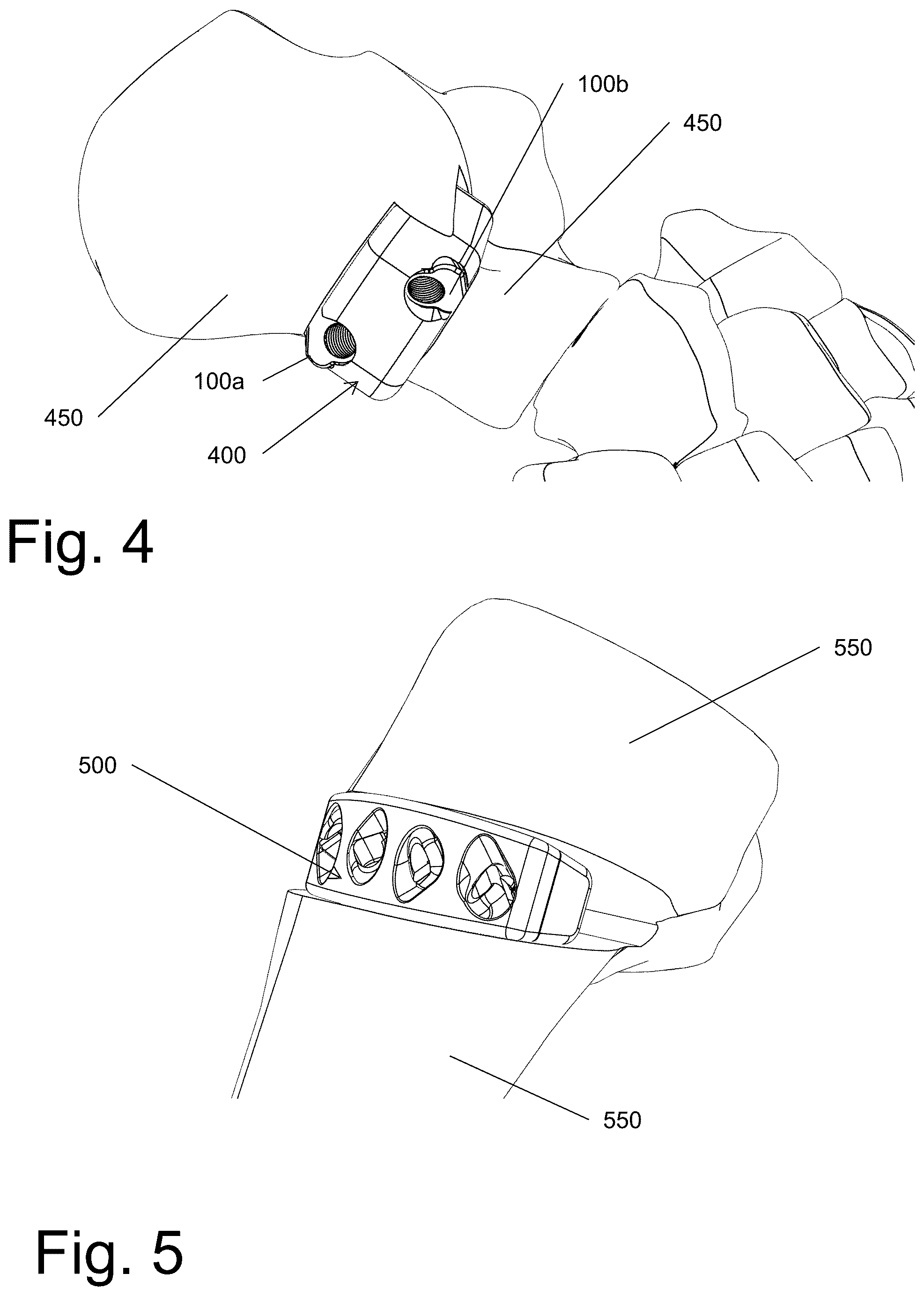 Patent US12599483 Figure 9 – System and method for joining boney structures