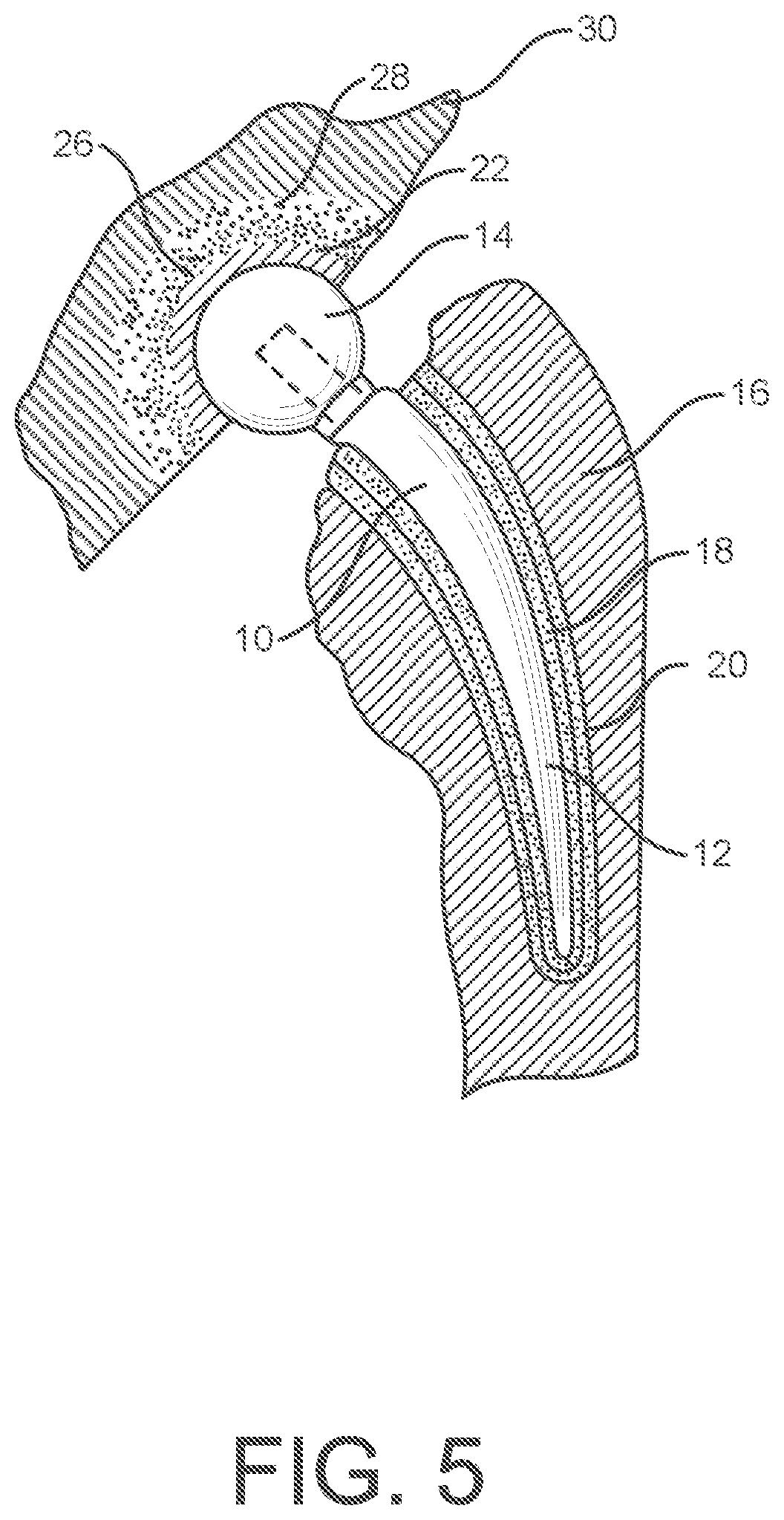 Patent US12599484 Figure 5 – Polishing device for orthopedic devices