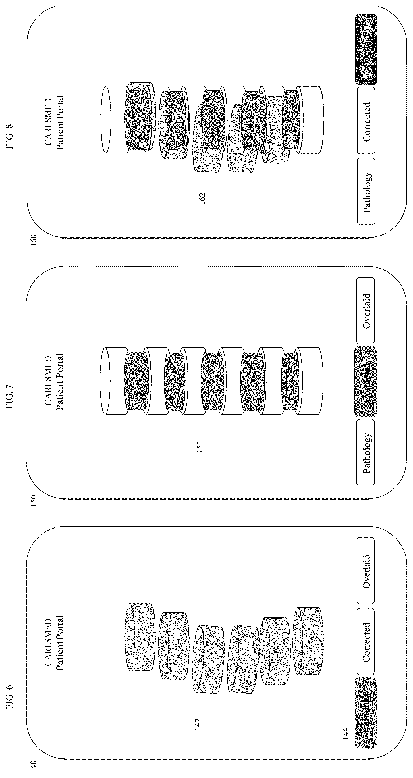 Patent US12599485 Figure 6 – Systems and methods for orthopedic implants