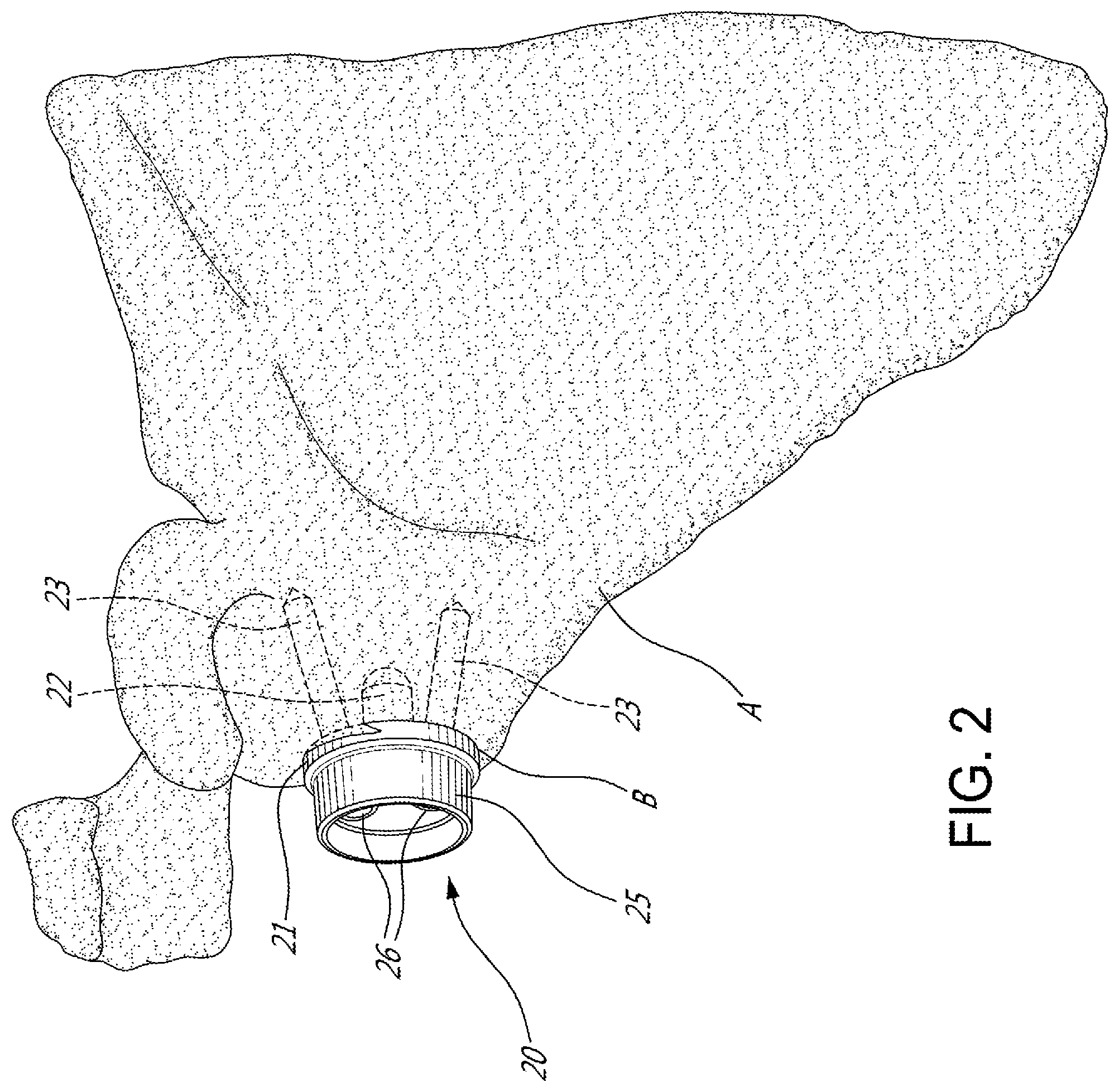 Patent US12599486 Figure 2 – Glenoid implant surgery using patient specific instrumentation