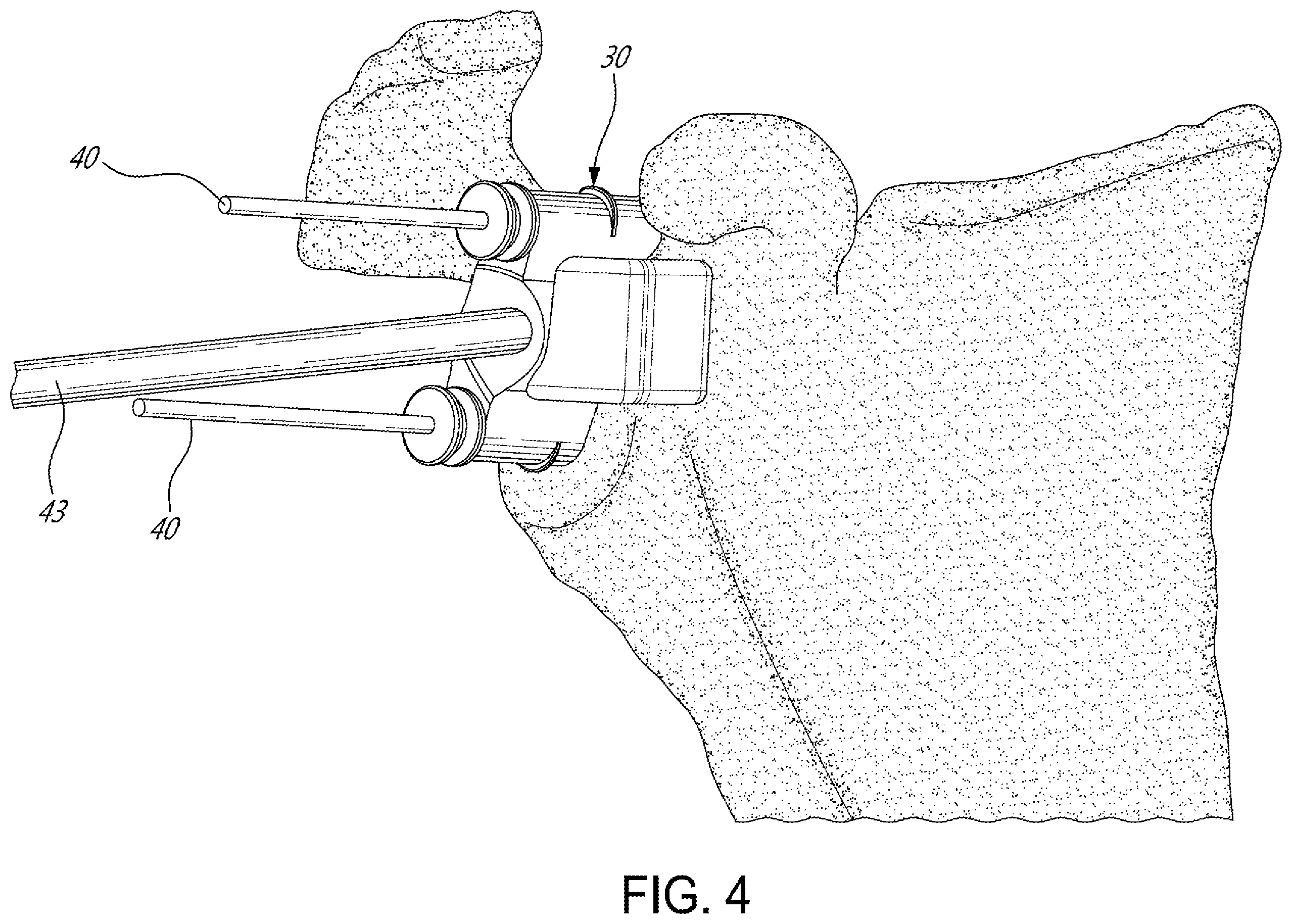 Patent US12599486 Figure 4 – Glenoid implant surgery using patient specific instrumentation