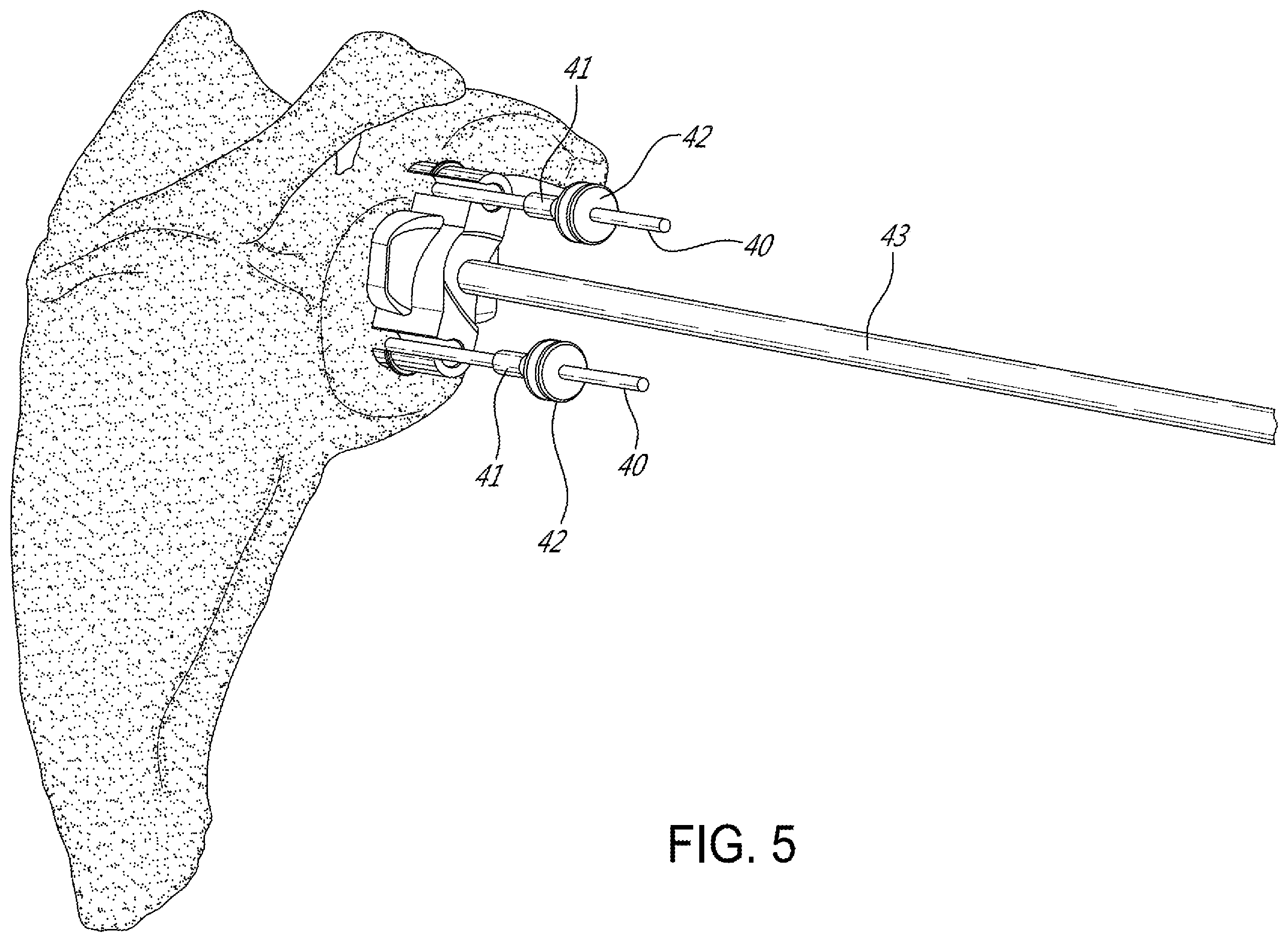 Patent US12599486 Figure 5 – Glenoid implant surgery using patient specific instrumentation