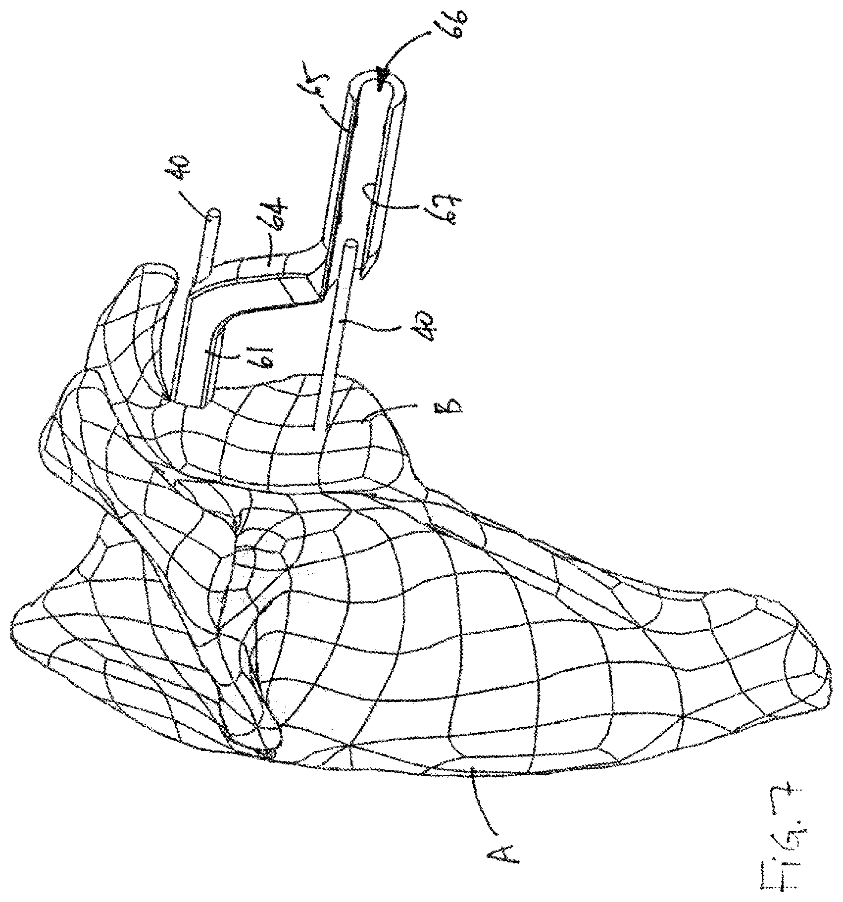 Patent US12599486 Figure 7 – Glenoid implant surgery using patient specific instrumentation