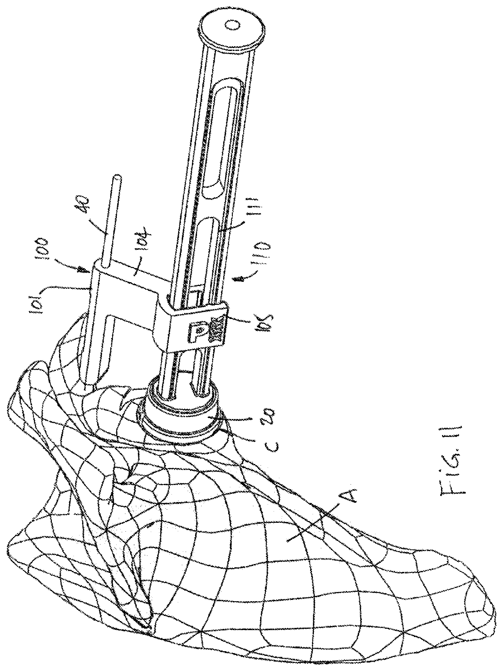 Patent US12599486 Figure 11 – Glenoid implant surgery using patient specific instrumentation