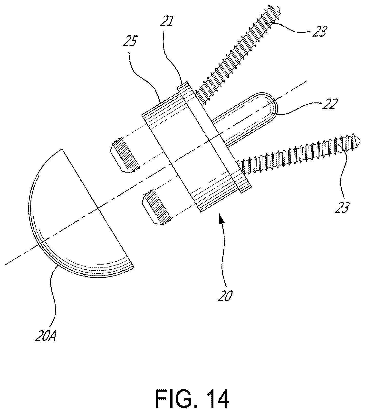 Patent US12599486 Figure 14 – Glenoid implant surgery using patient specific instrumentation
