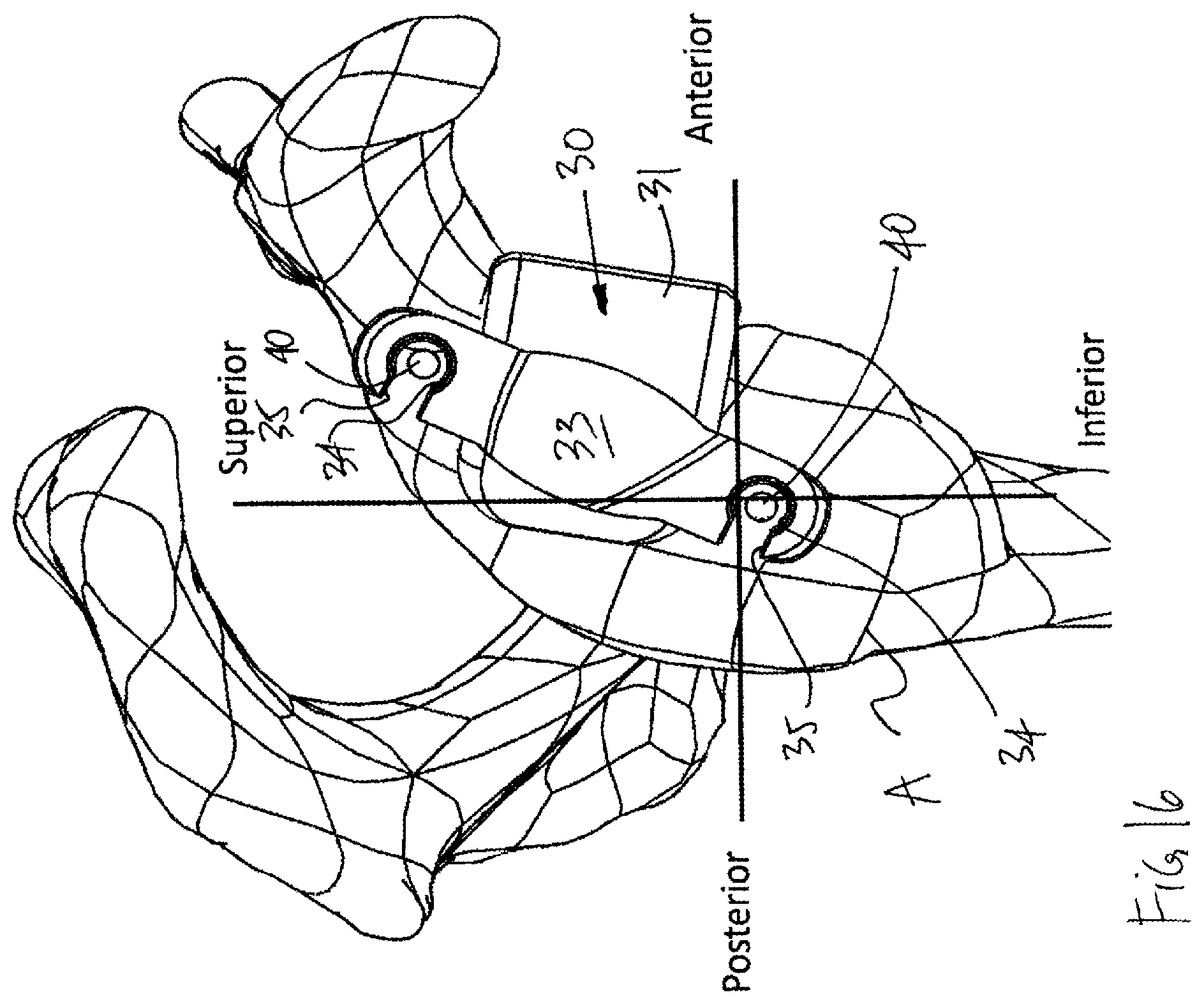 Patent US12599486 Figure 16 – Glenoid implant surgery using patient specific instrumentation